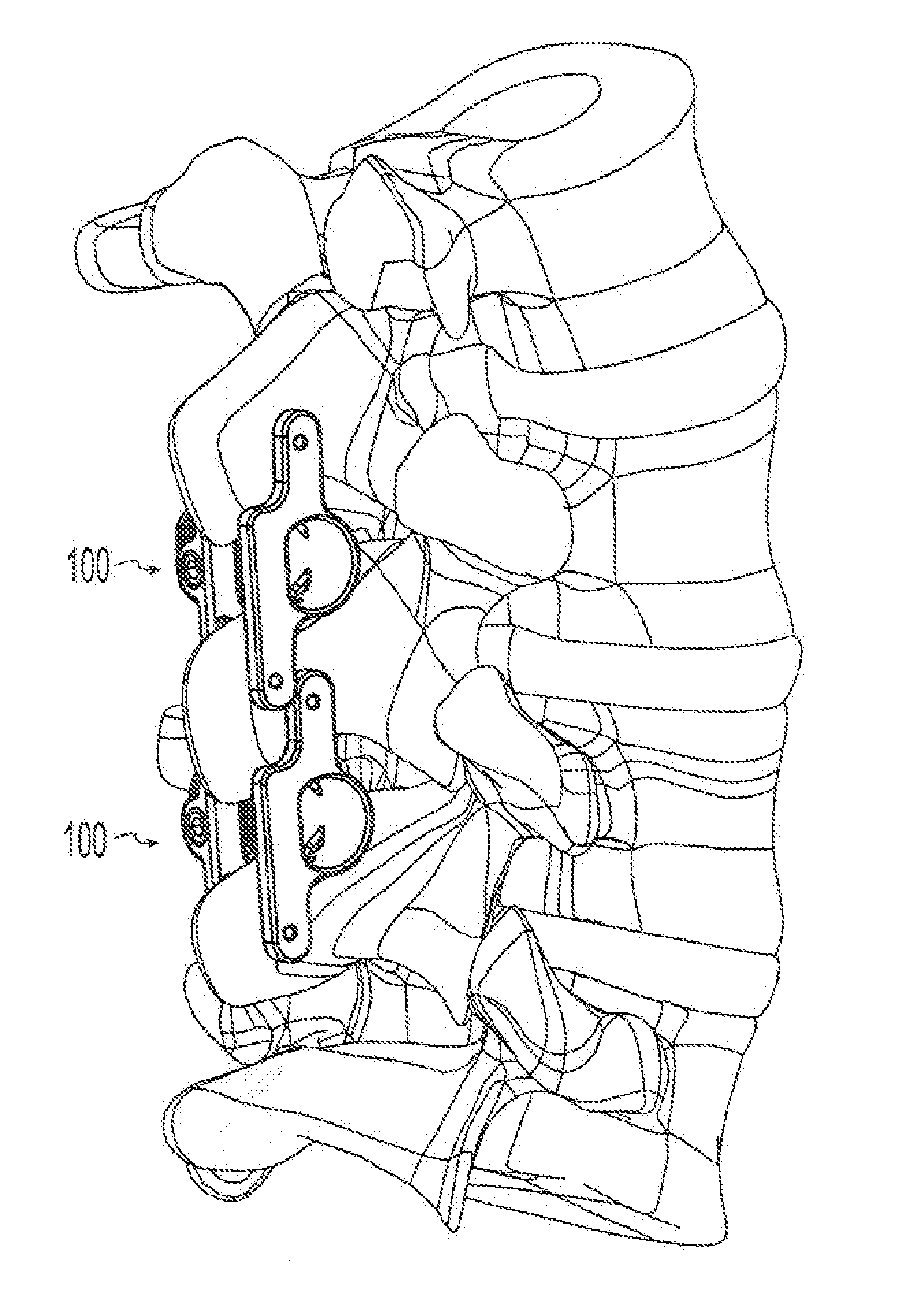 Methods for compression fracture treatment with spinous process fixation systems