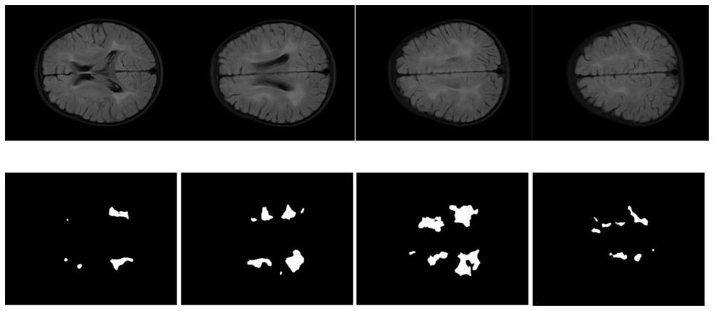 Deep fusion learning-based child brain MRI demyelination auxiliary analysis method