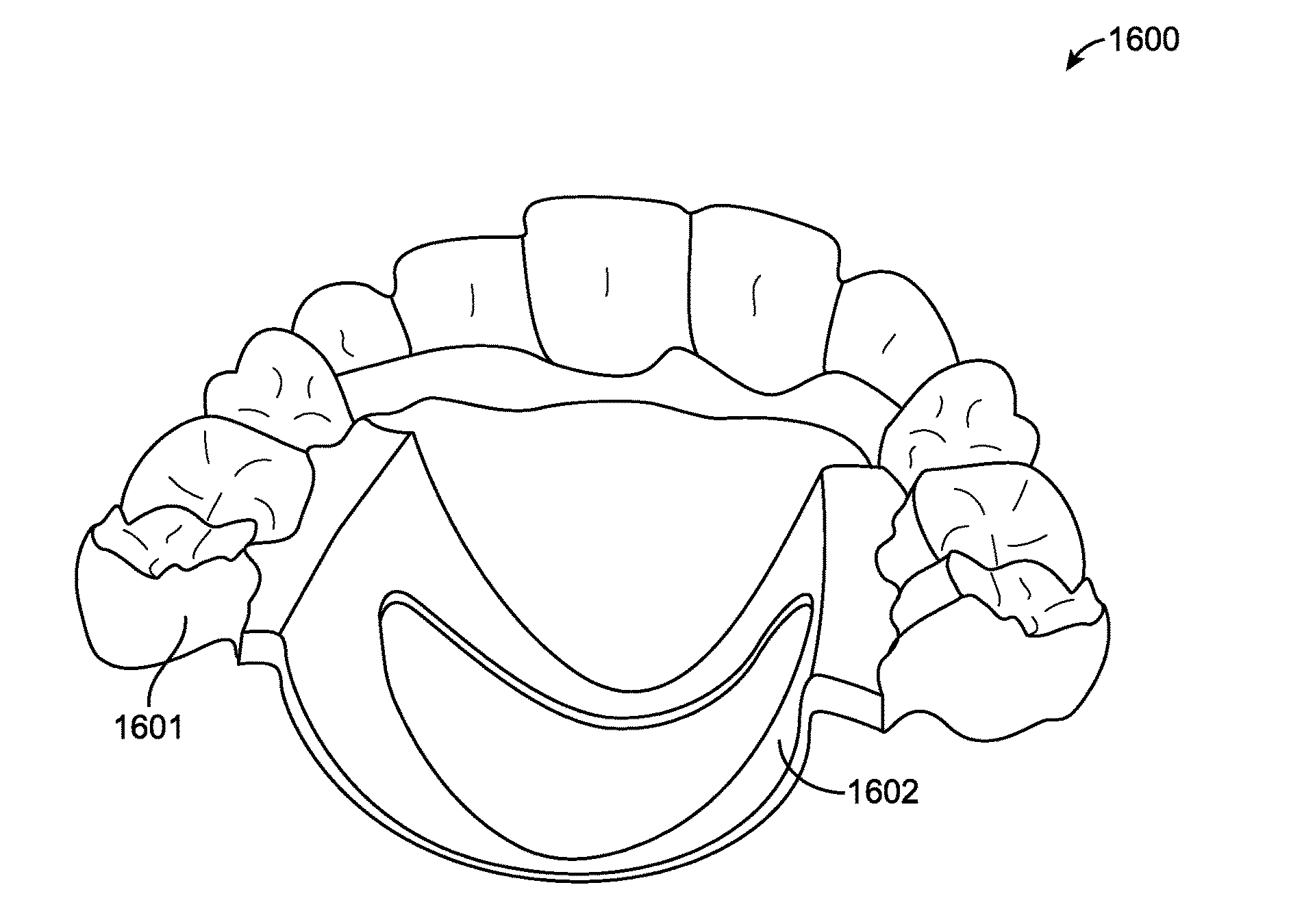 Direct fabrication of aligners for palate expansion and other applications
