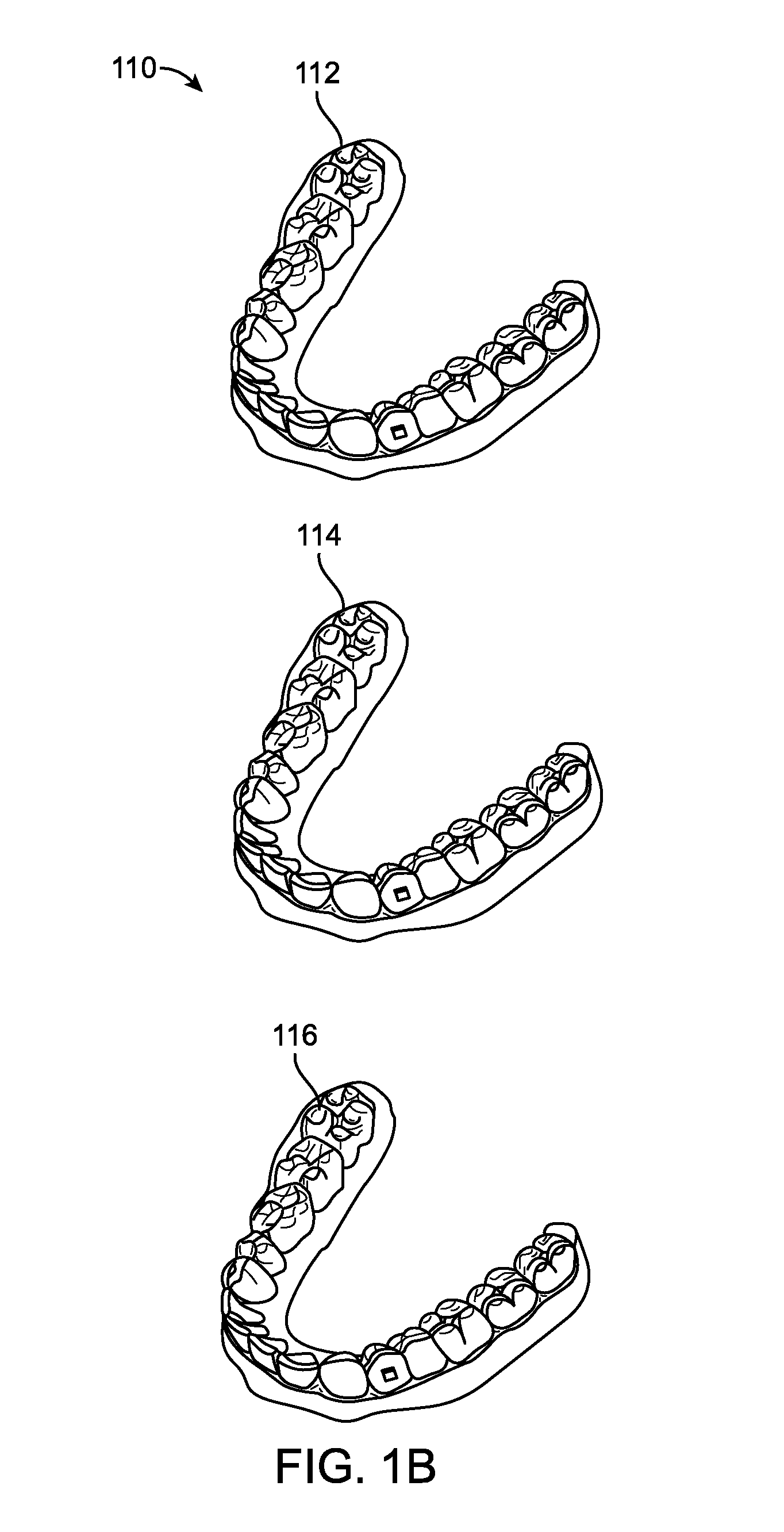 Direct fabrication of aligners for palate expansion and other applications