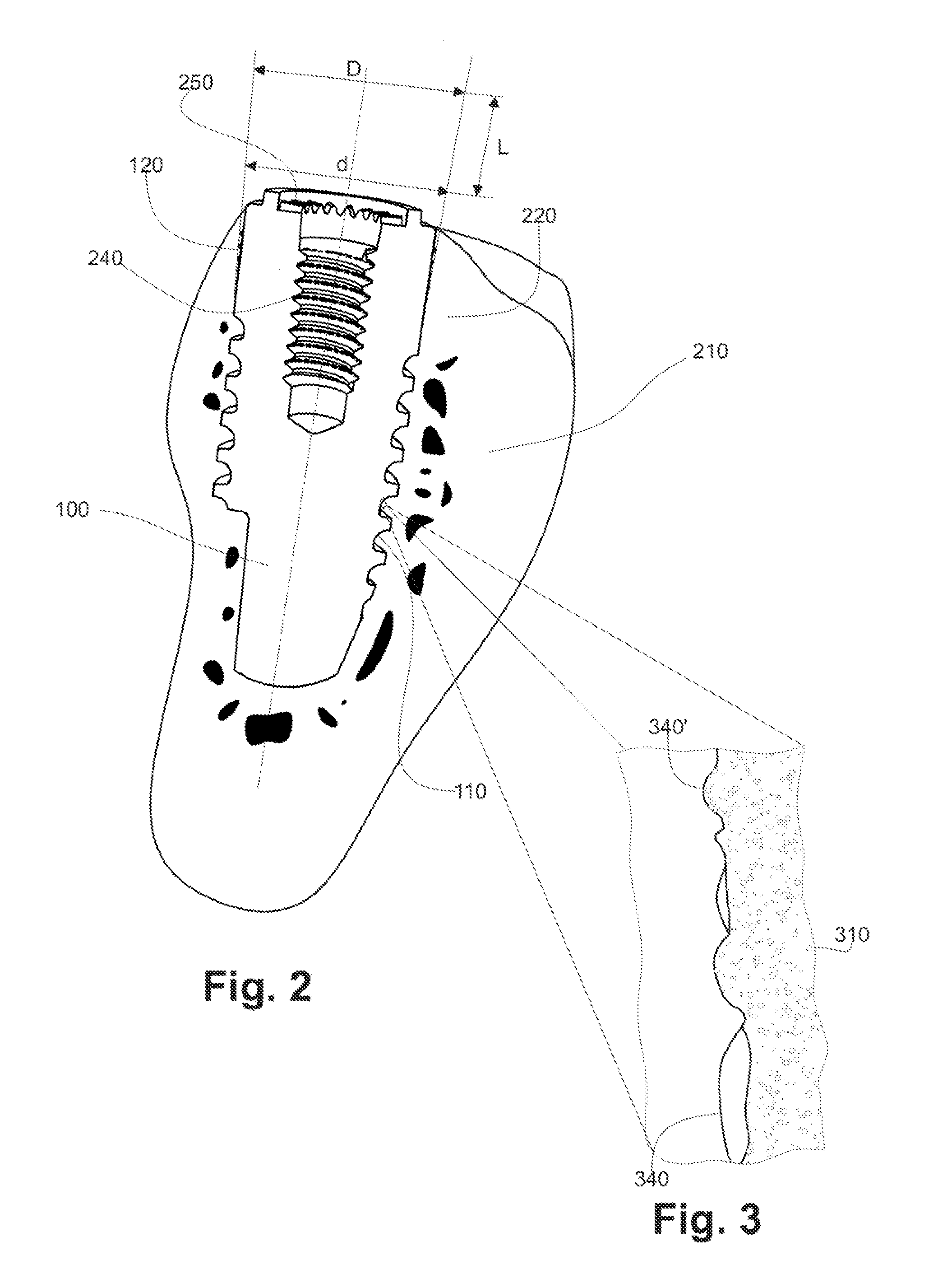 Endosseous implant and method for production thereof