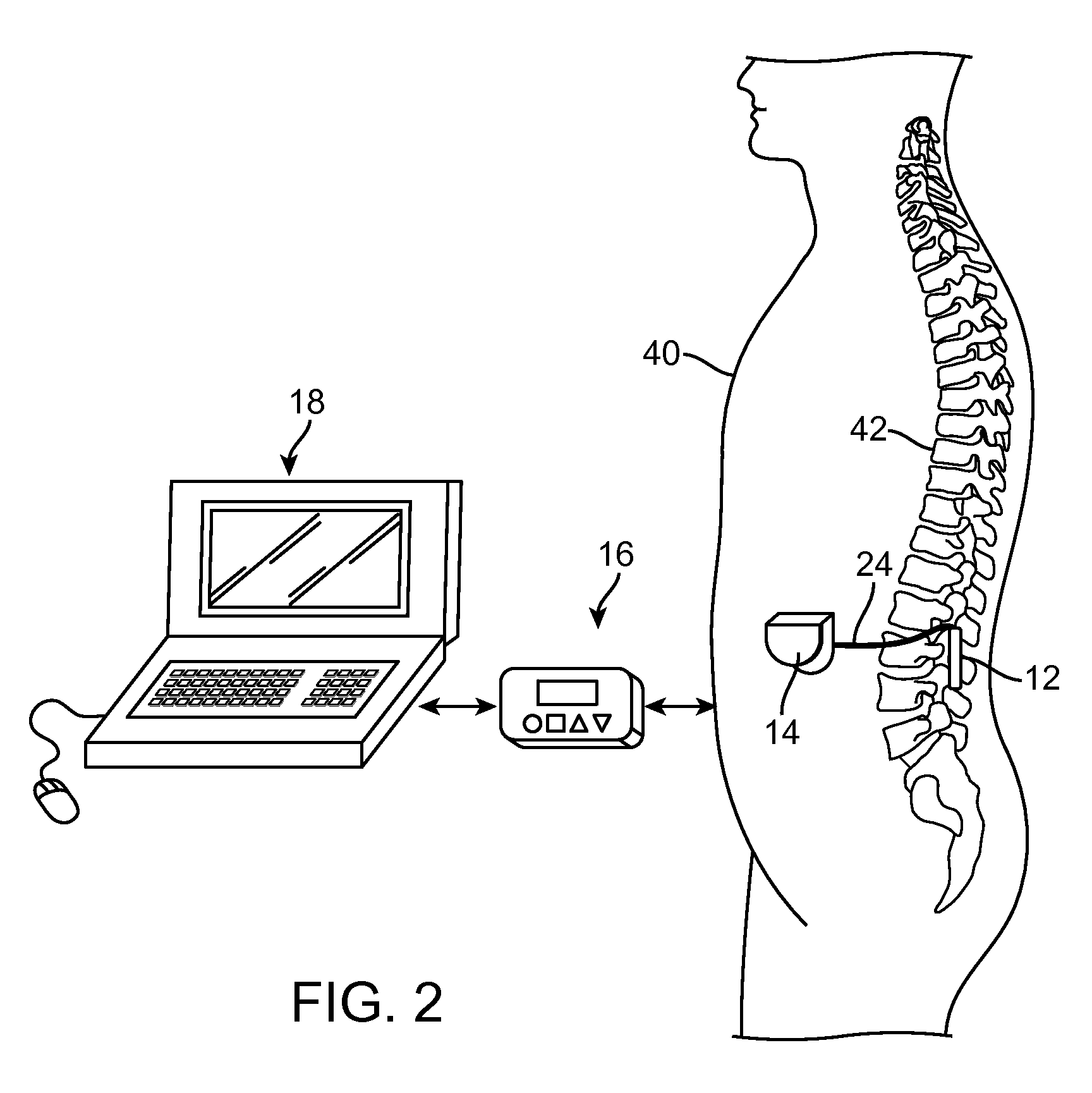System and method for electrical modulation of the posterior Longitudinal ligament