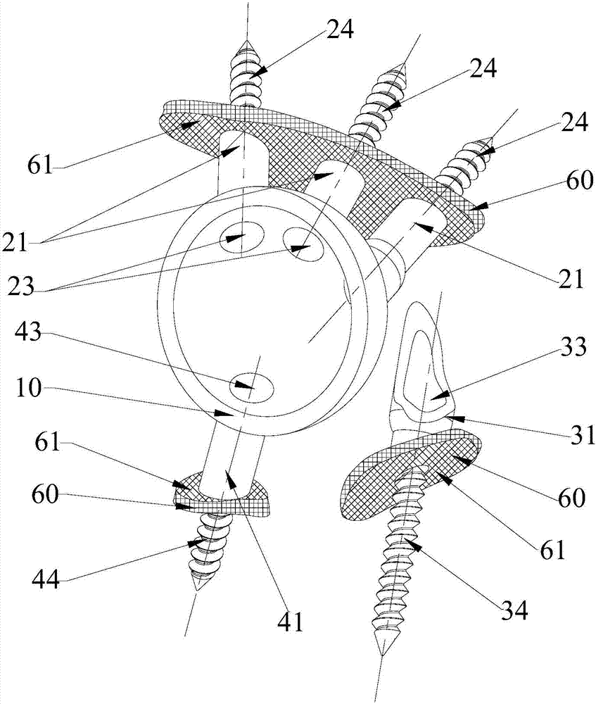 Peri-acetabular prosthesis structure