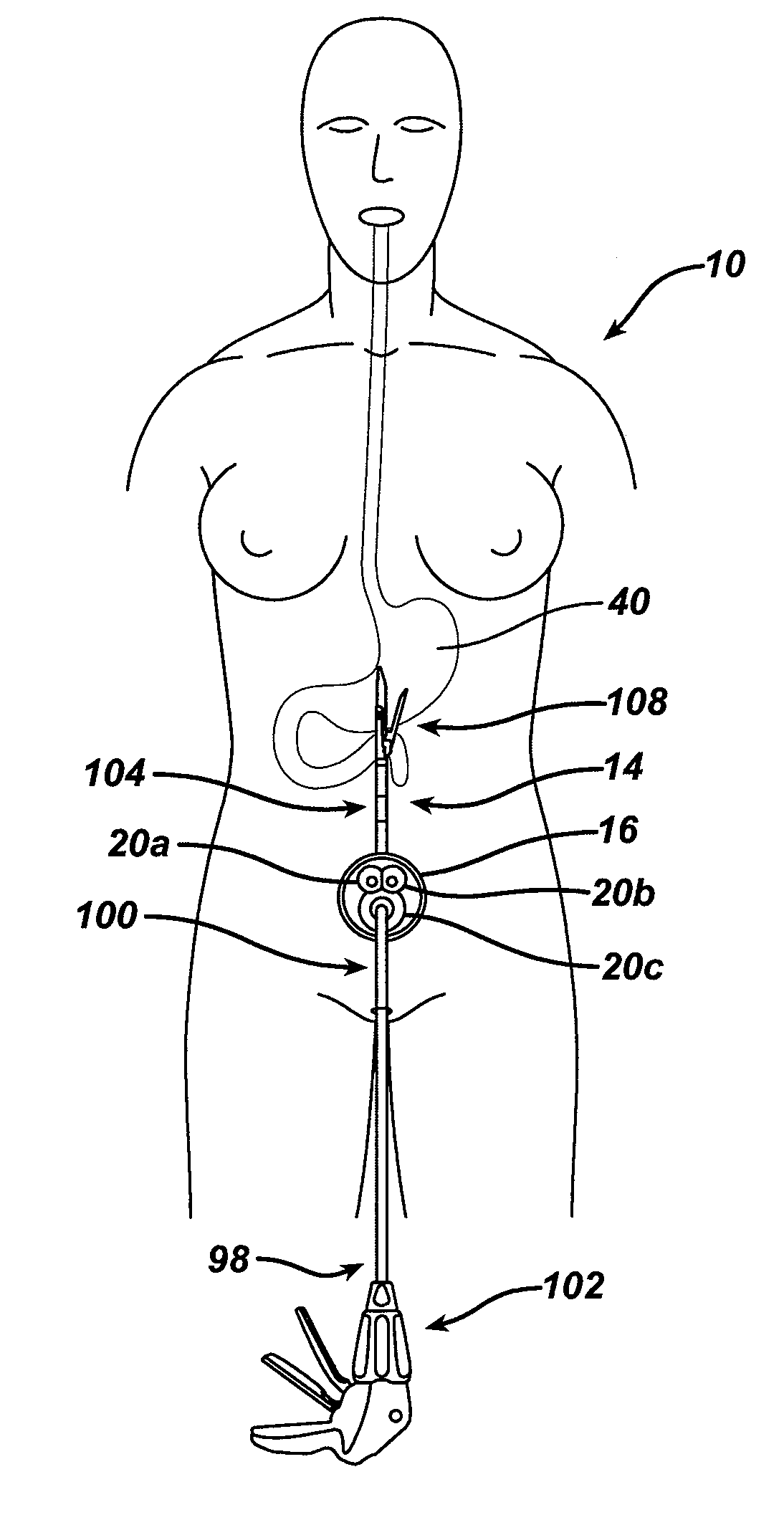 Methods and devices for performing gastroplasties using a multiple port access device