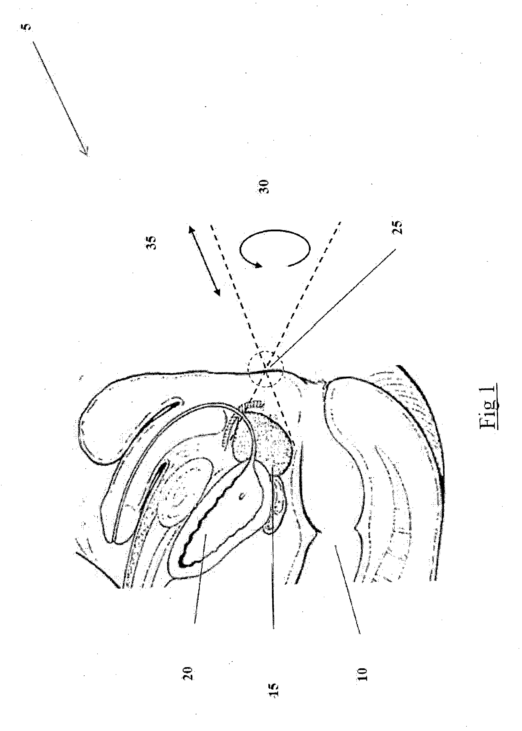 An apparatus and method for biopsy and therapy