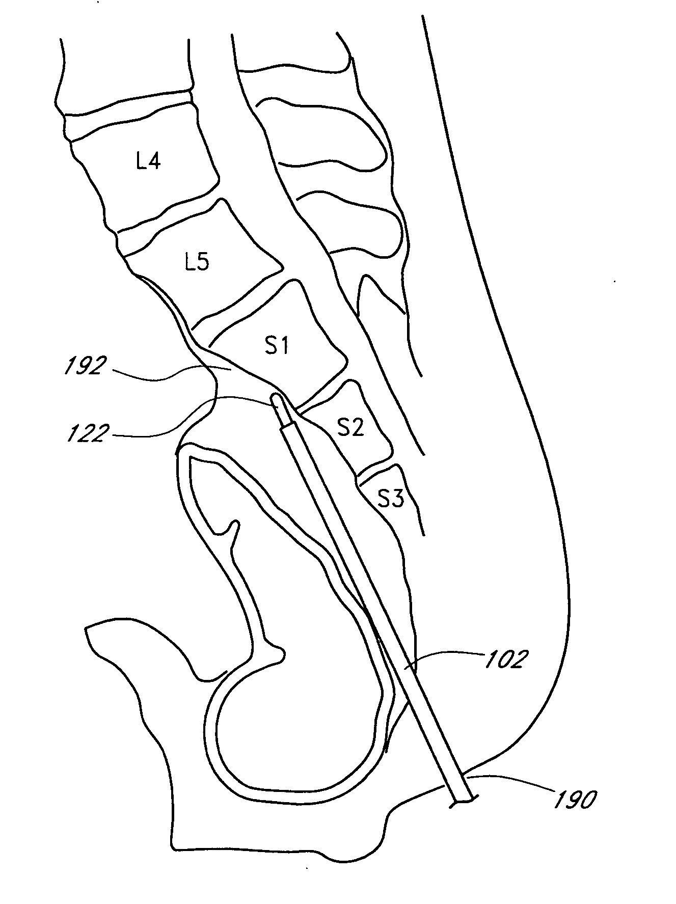 Method and apparatus for introducing material along an access path to a treatment site