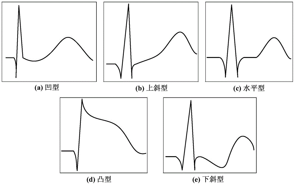 Automatic classification method for ST-segment evaluation patterns in electrocardiograph signals