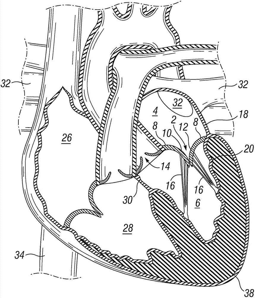 Prosthetic valve used to replace the mitral valve