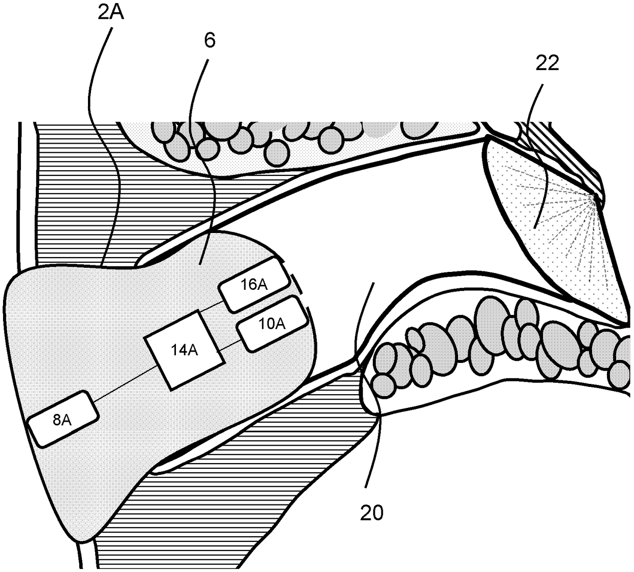 Methods of estimating ear geometry and related hearing devices