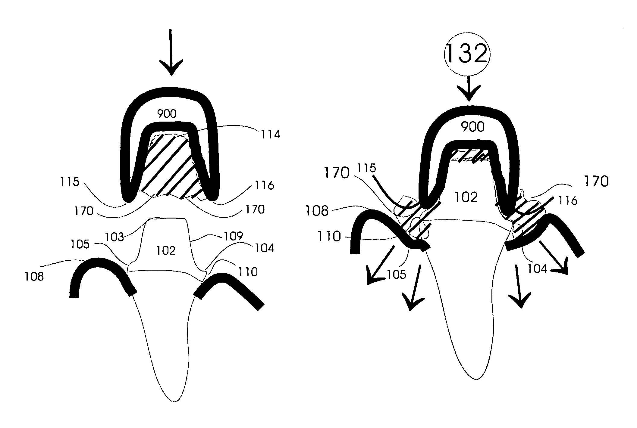 Gingival retraction device and method