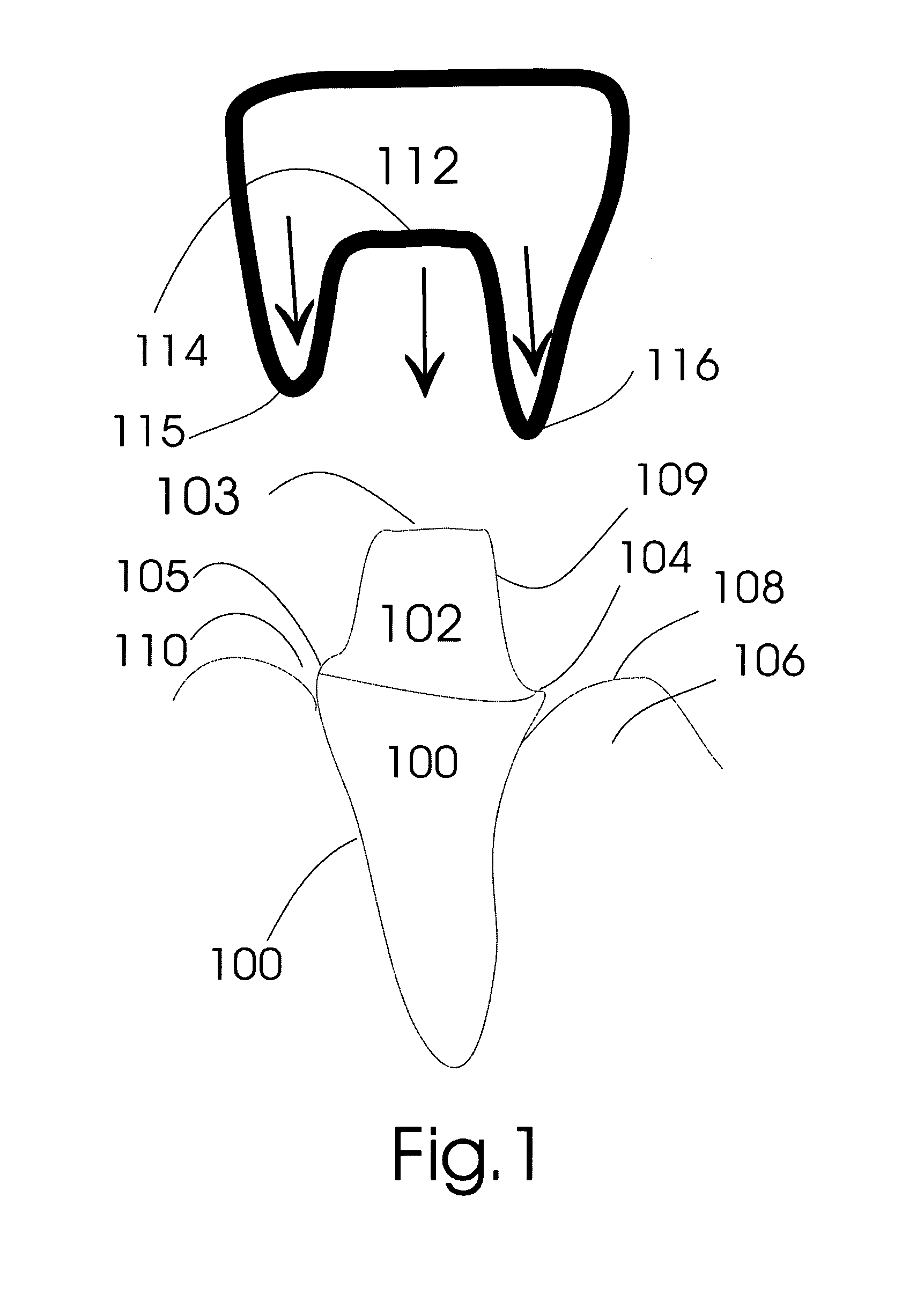 Gingival retraction device and method