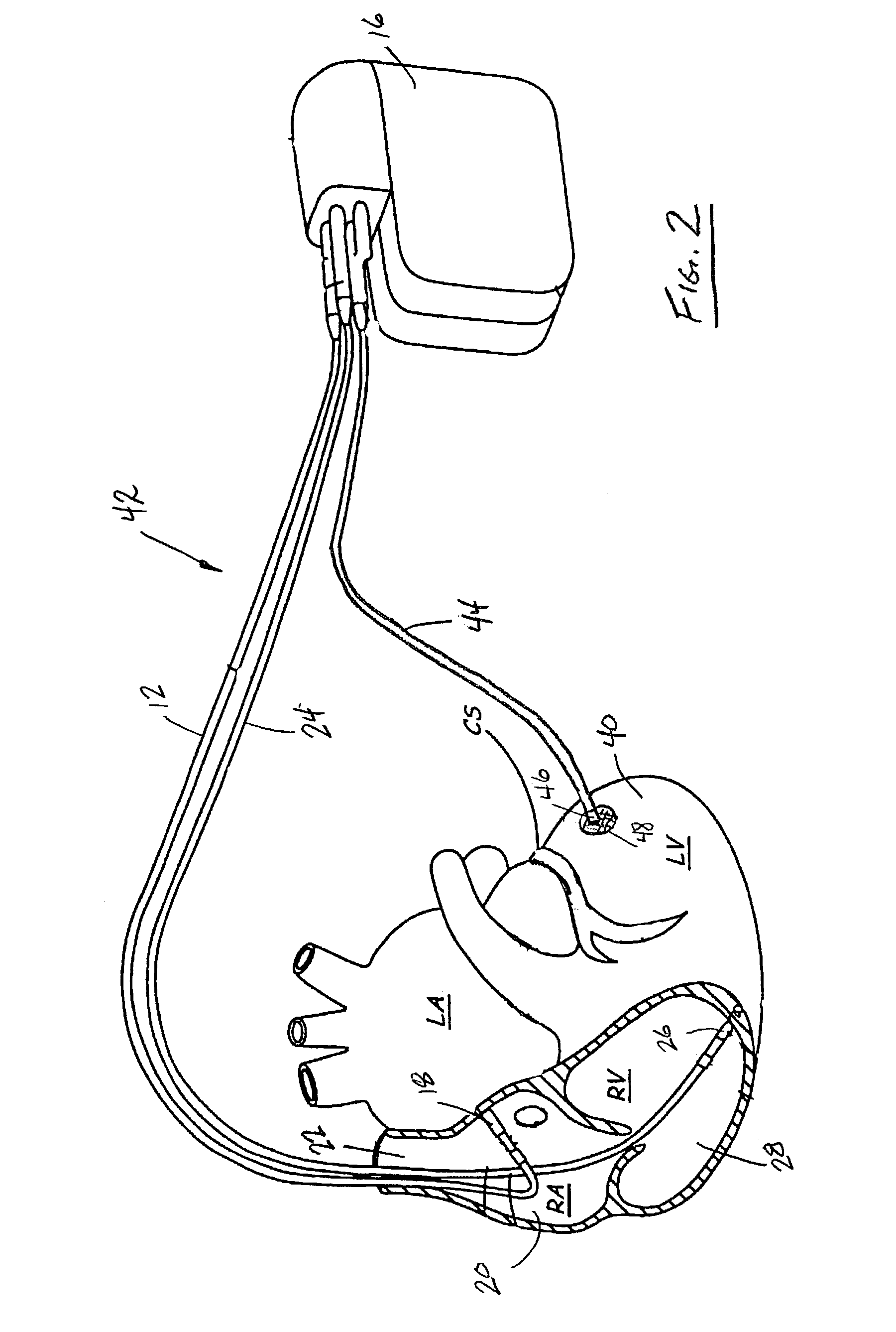 Epicardial lead placement for bi-ventricular pacing using thoracoscopic approach