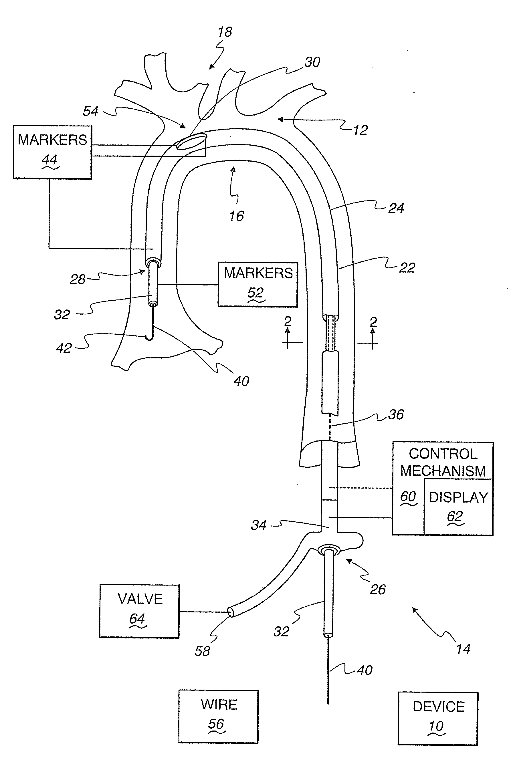 Method of controllably directing a device into a human vessel