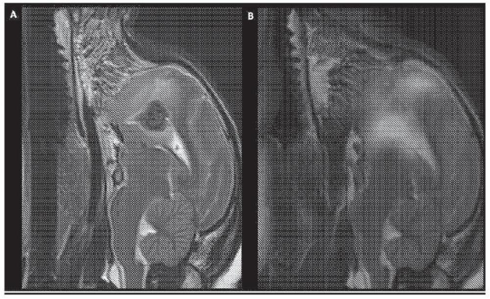 Radioactive microshperes for the treatment of CNS tumours