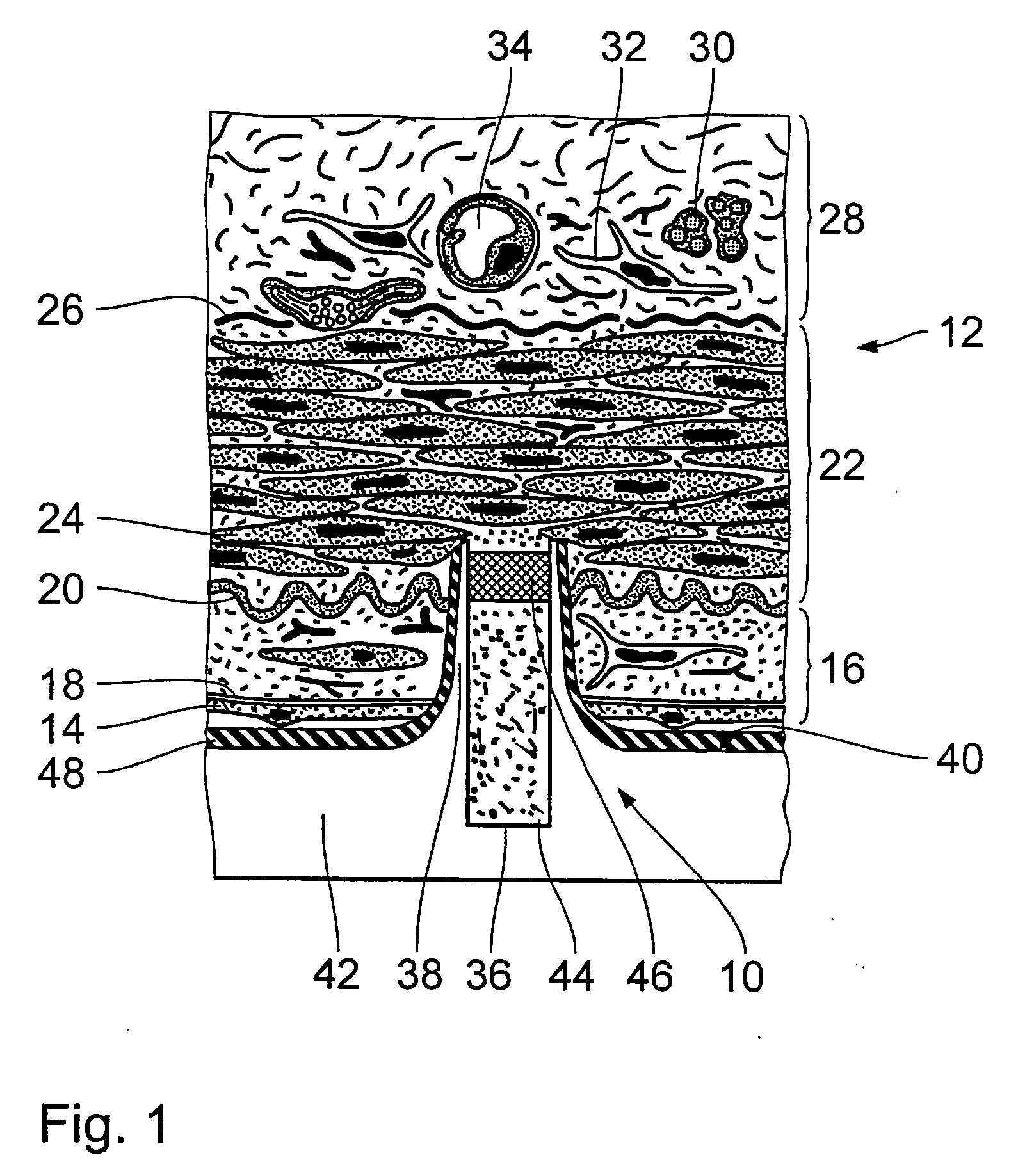 Endovascular implant for the injection of an active substance into the media of a blood vessel