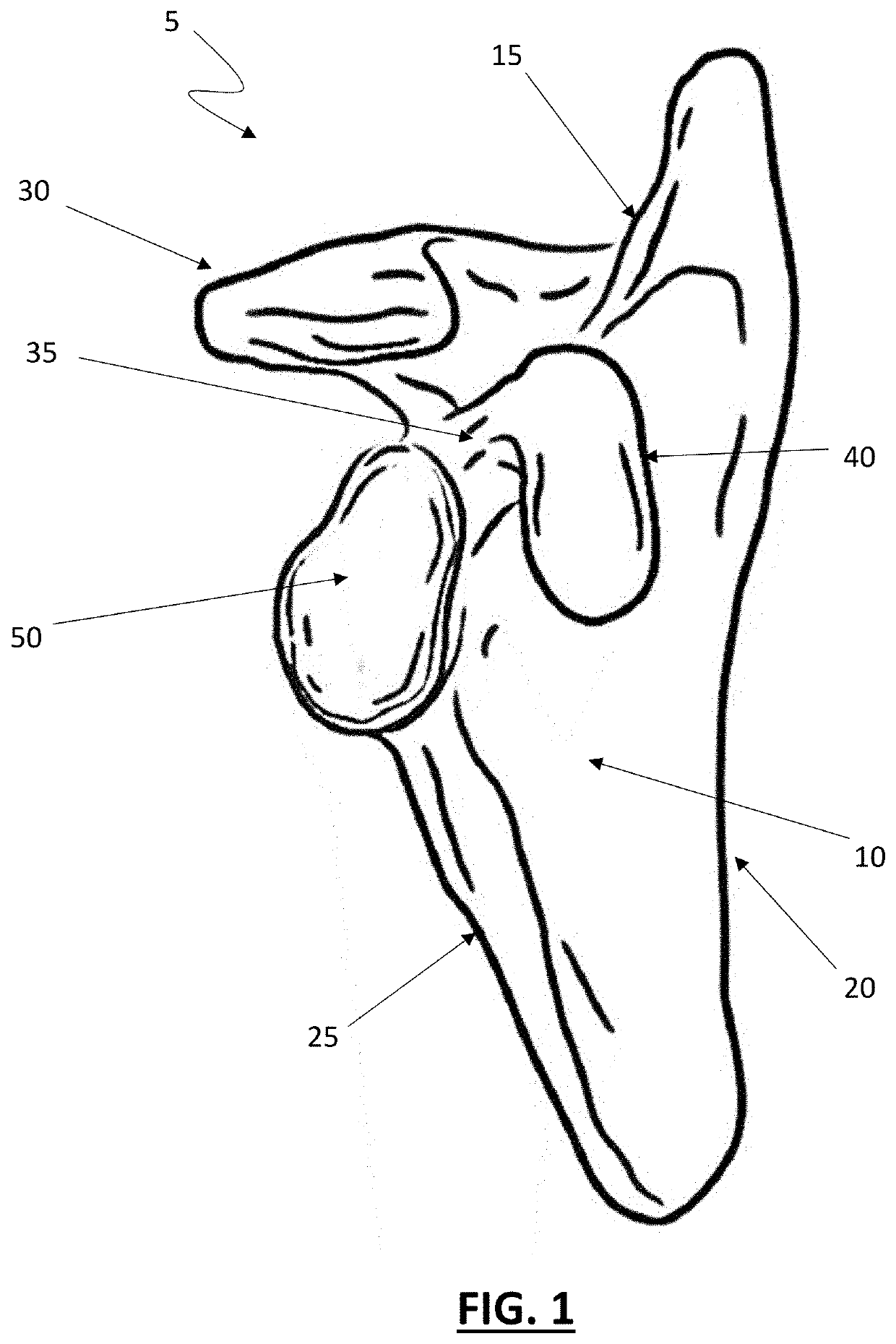 Partial glenoid arthroplasty