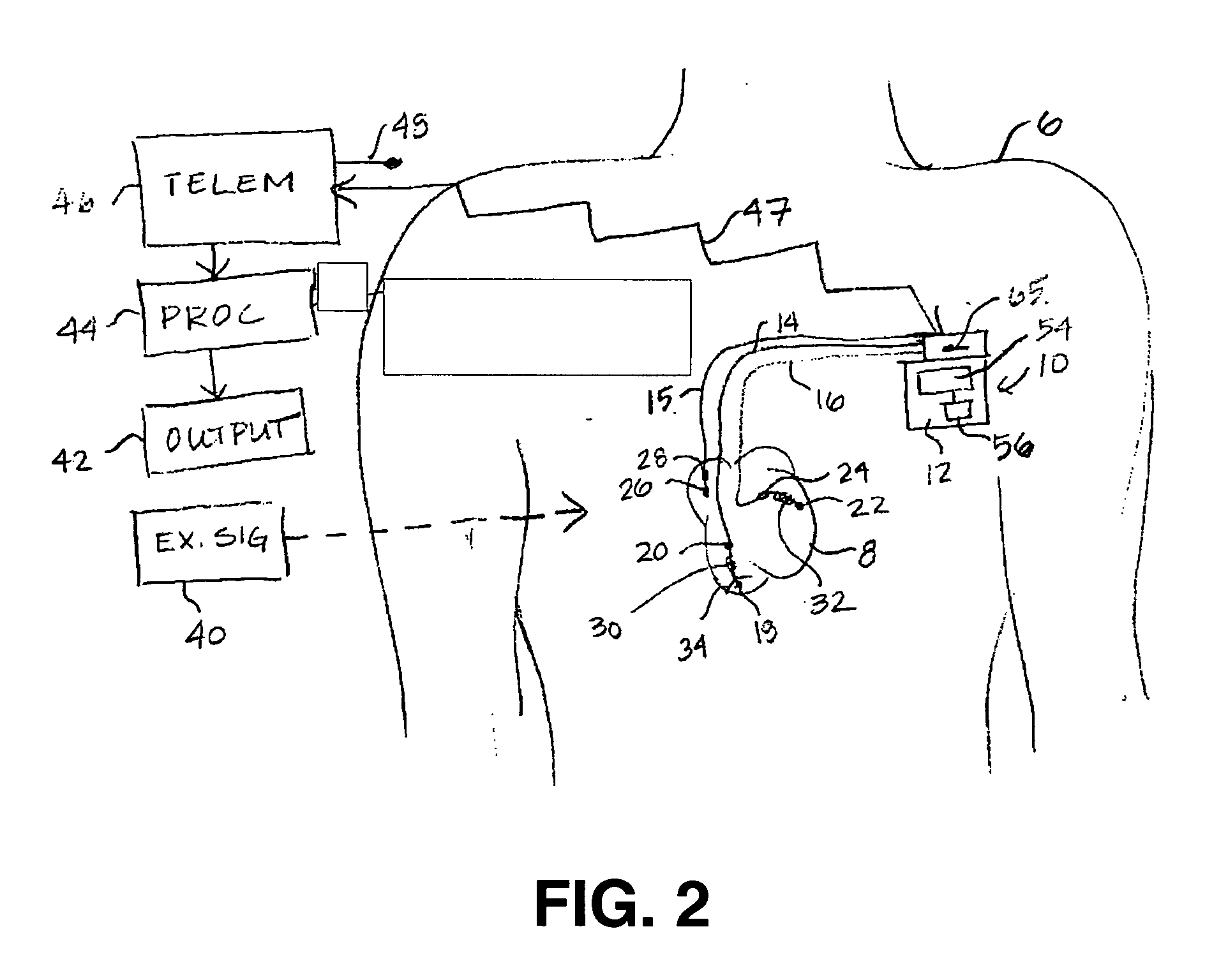 Pacemaker lead with motion sensor