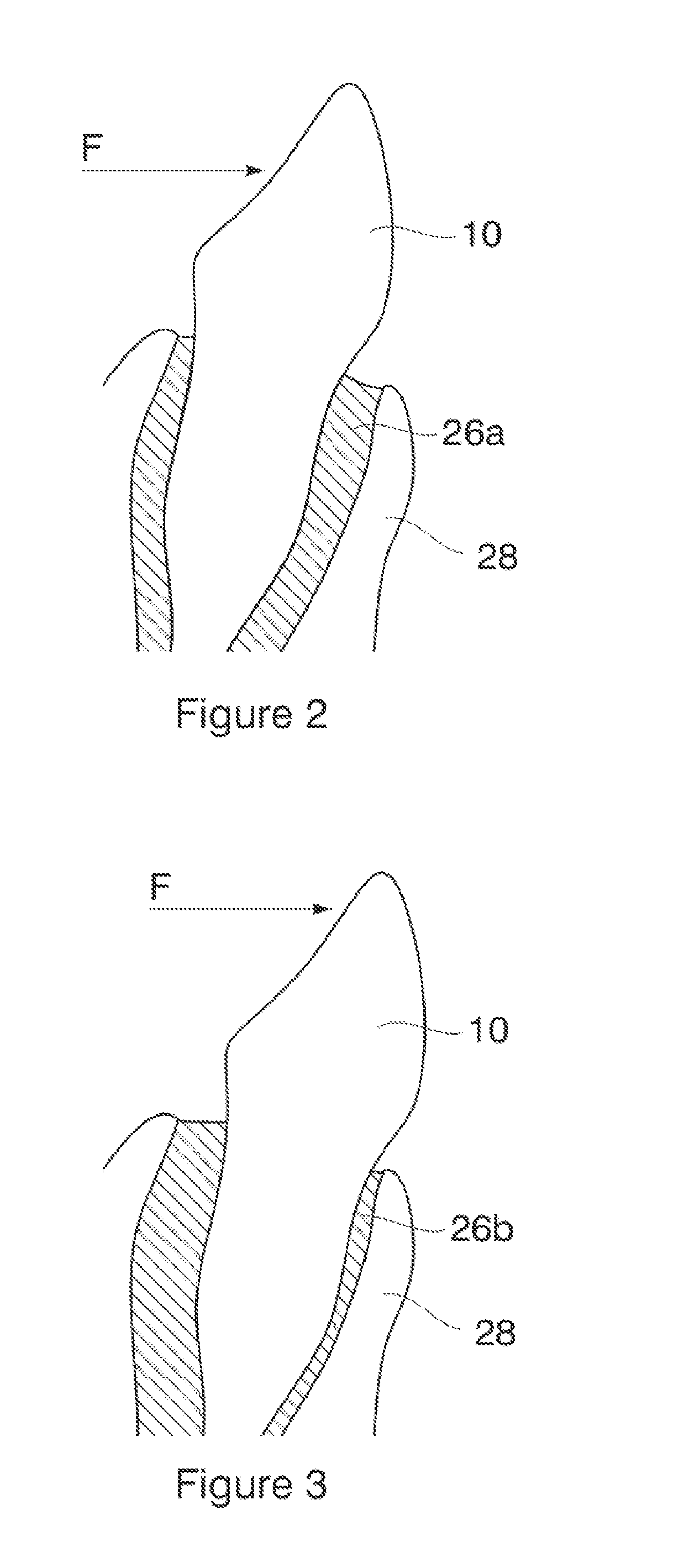 Orthodontic apparatus