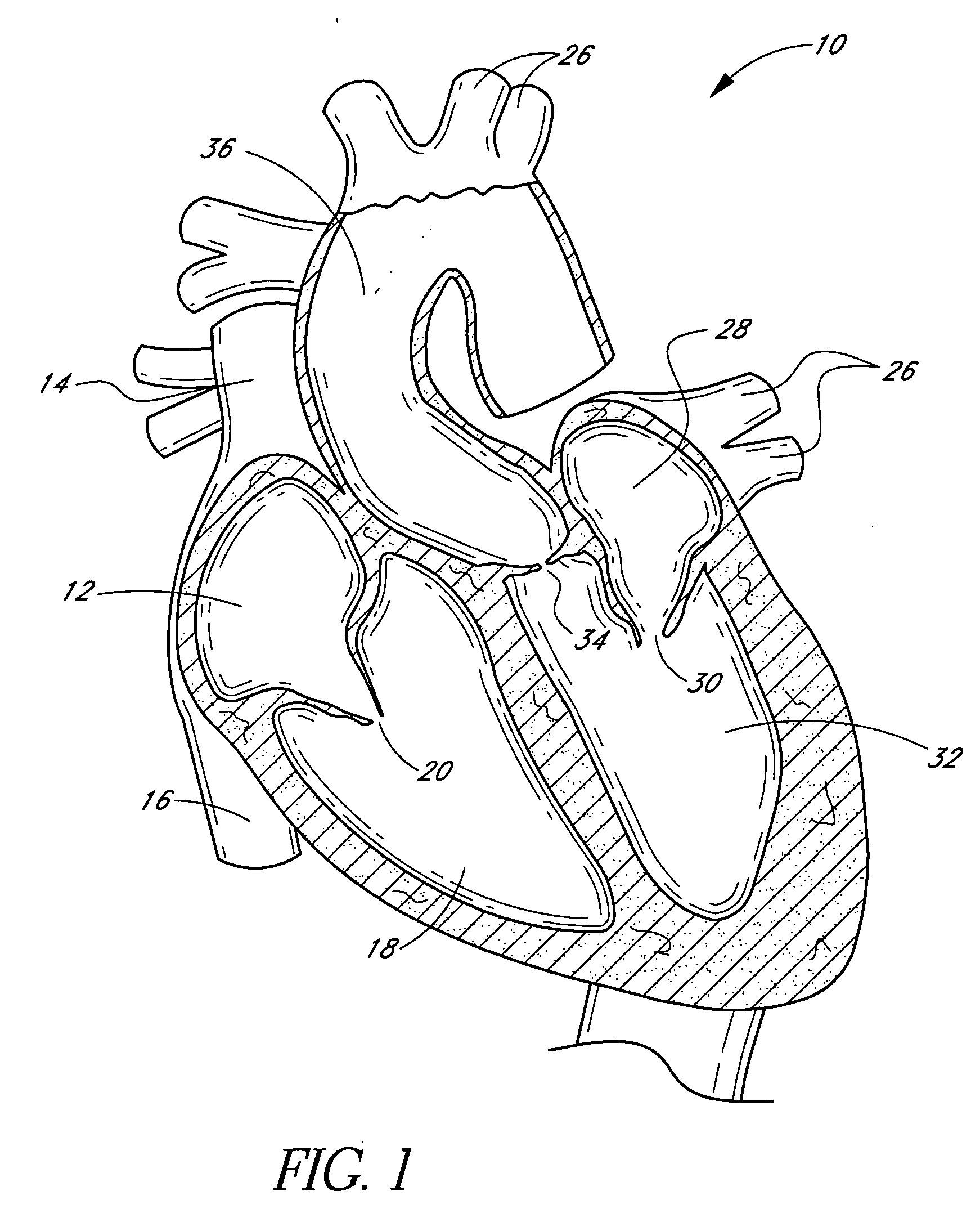 Method of in situ formation of translumenally deployable heart valve support