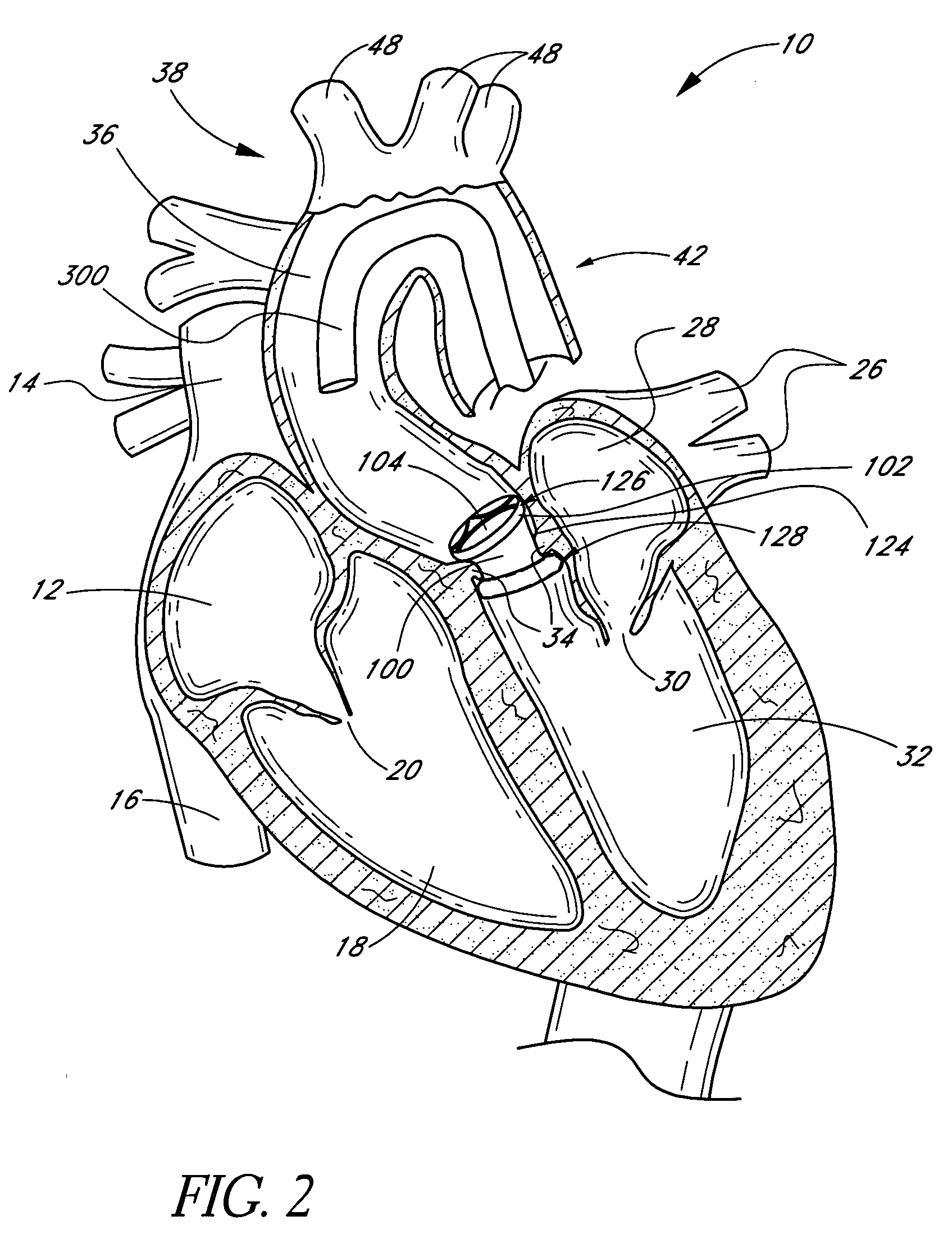 Method of in situ formation of translumenally deployable heart valve support