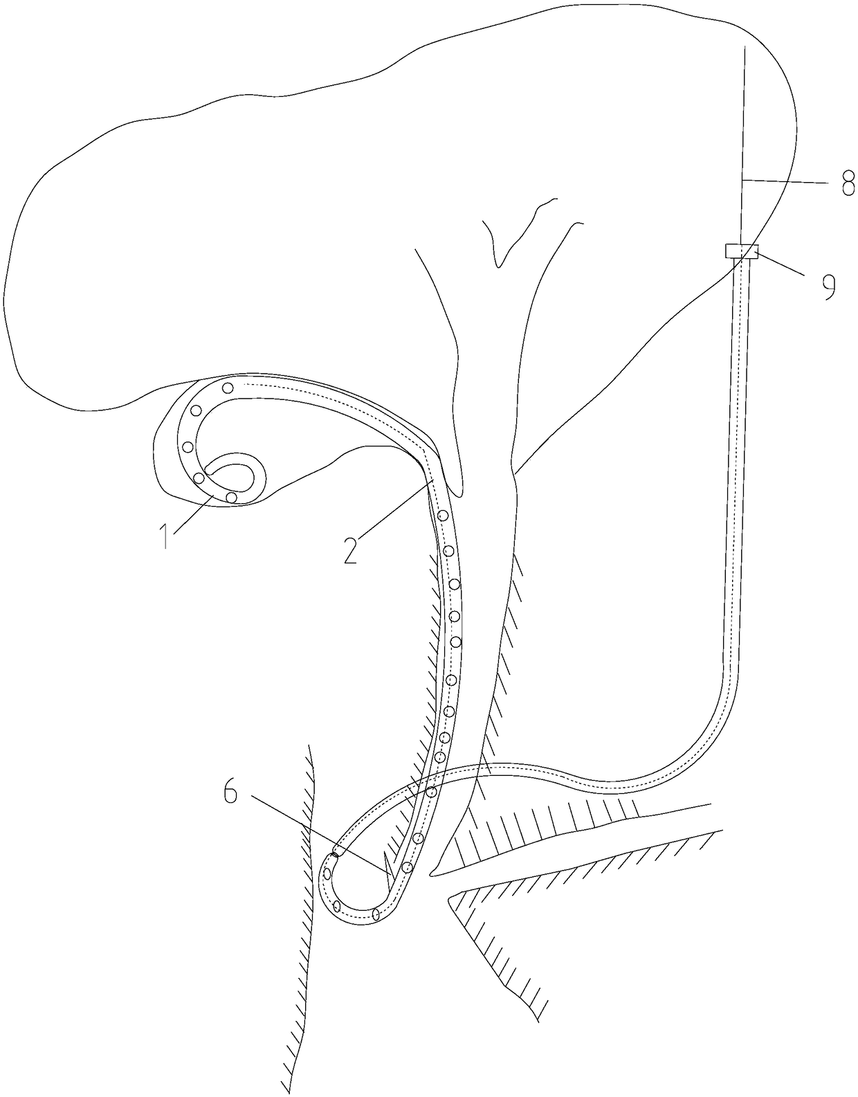 Internal gallbladder drainage tube
