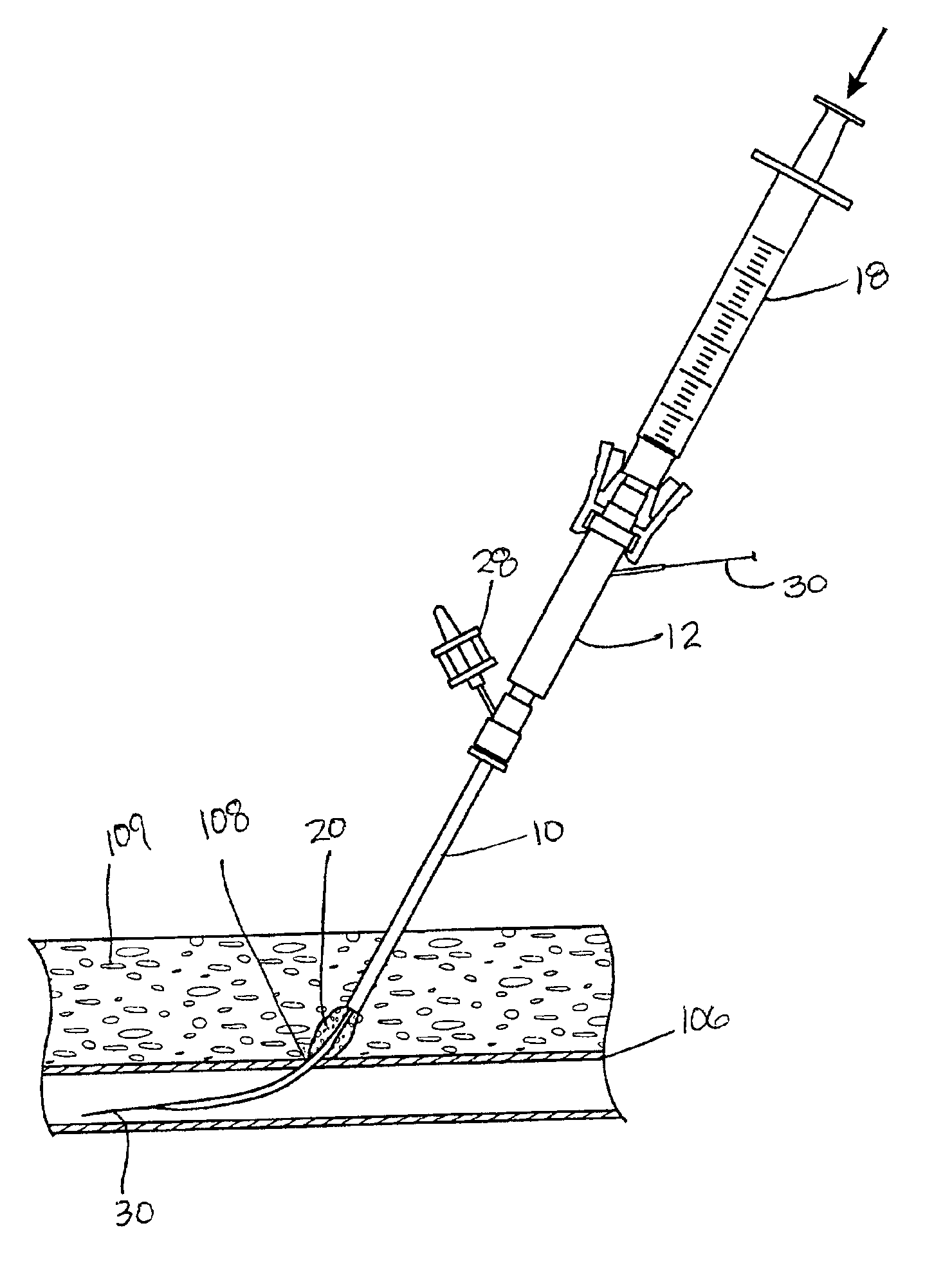 System and method for delivering hemostasis promoting material to a blood vessel puncture site by fluid pressure