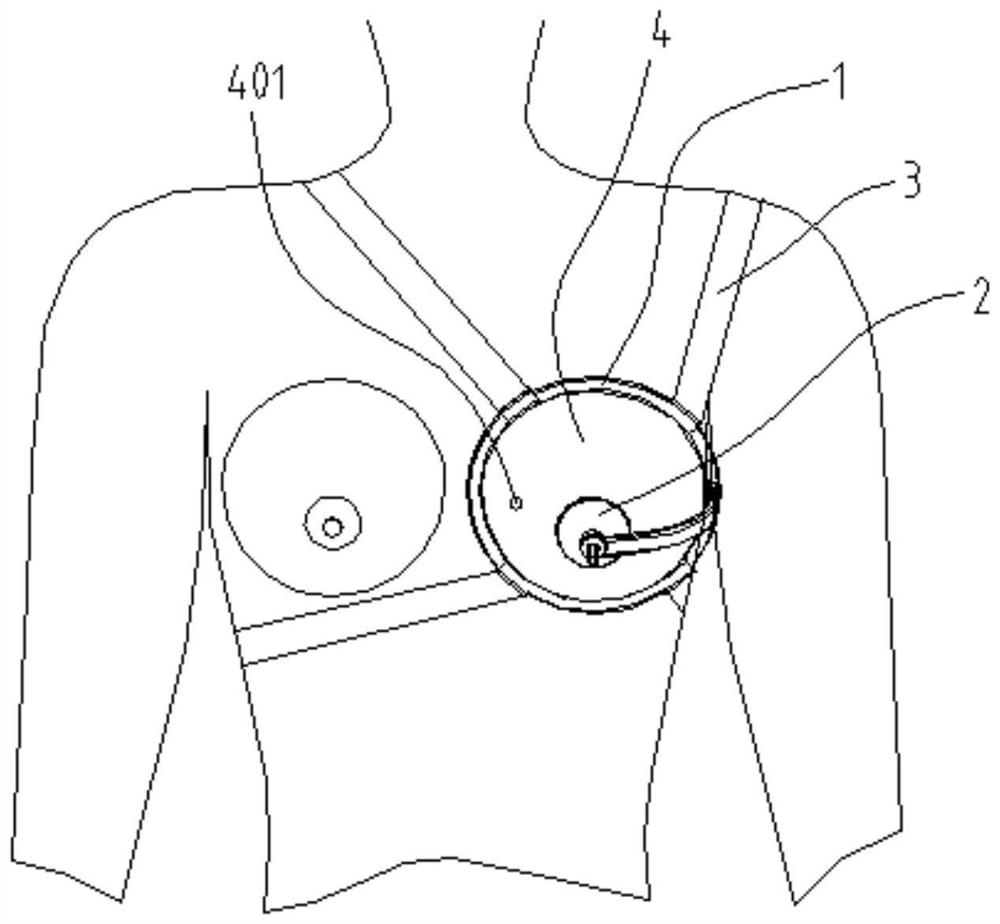 Breast fixing device