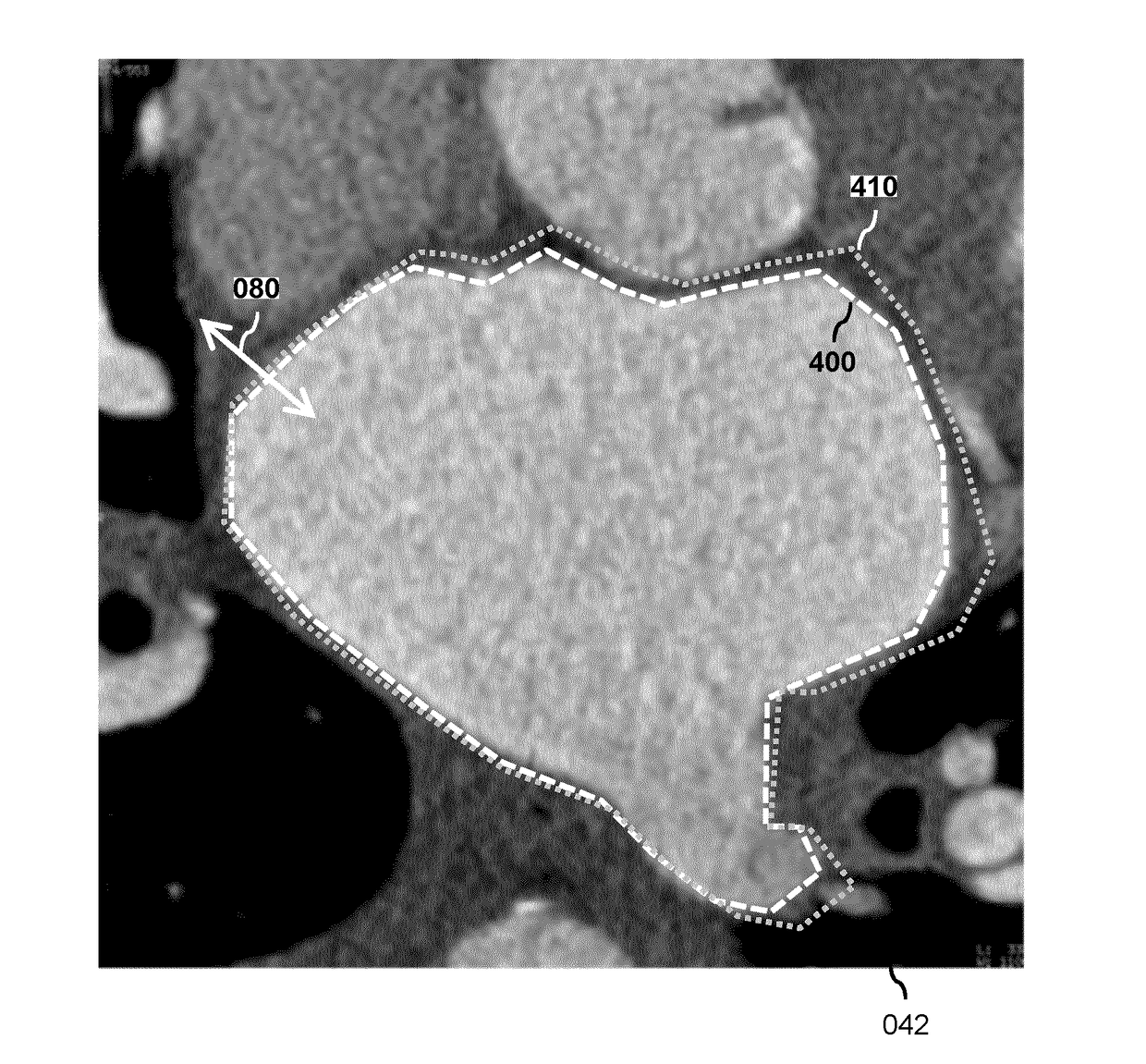 Model-based segmentation of an anatomical structure