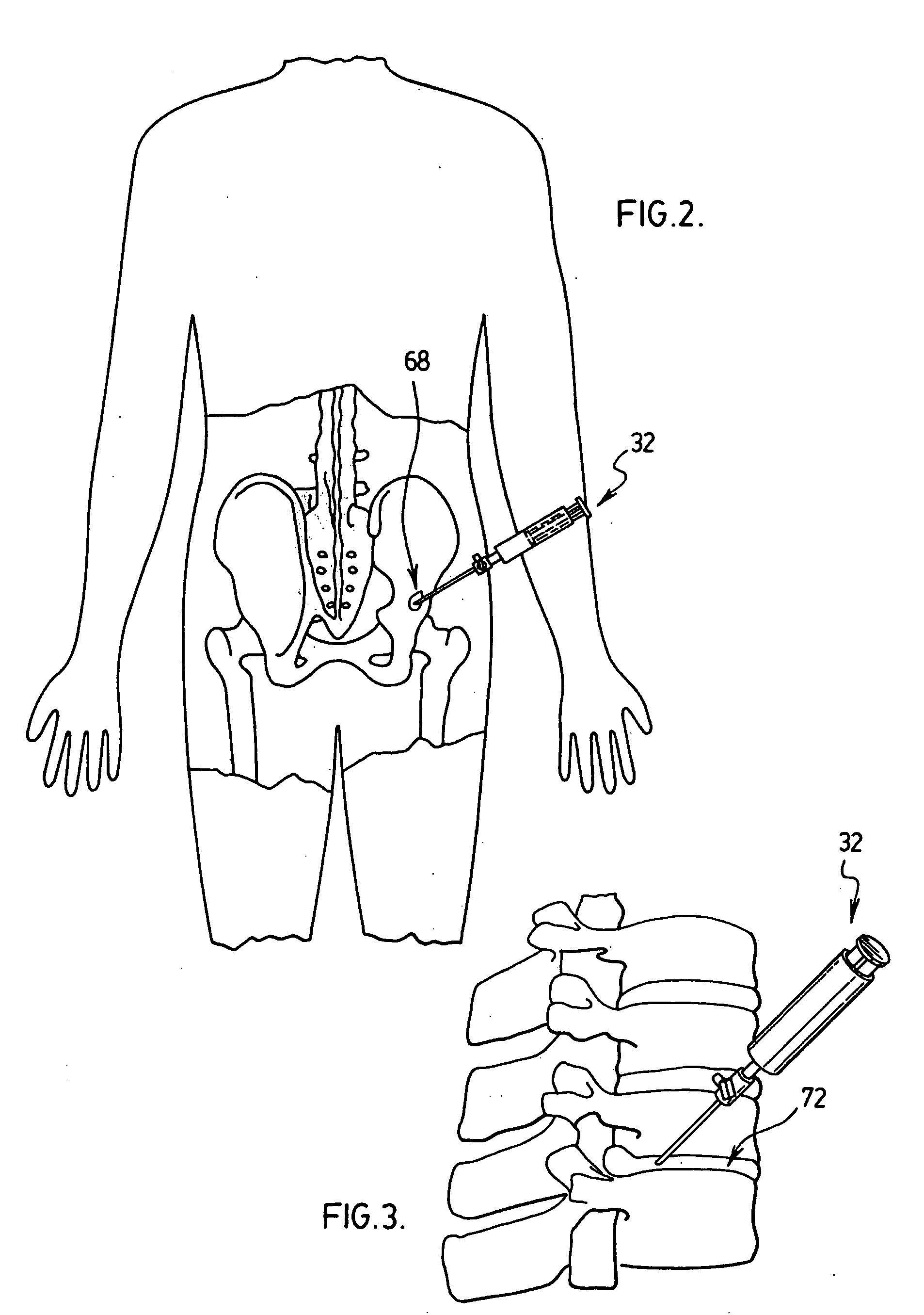 Apparatus and method for administering a therapeutic agent into tissue