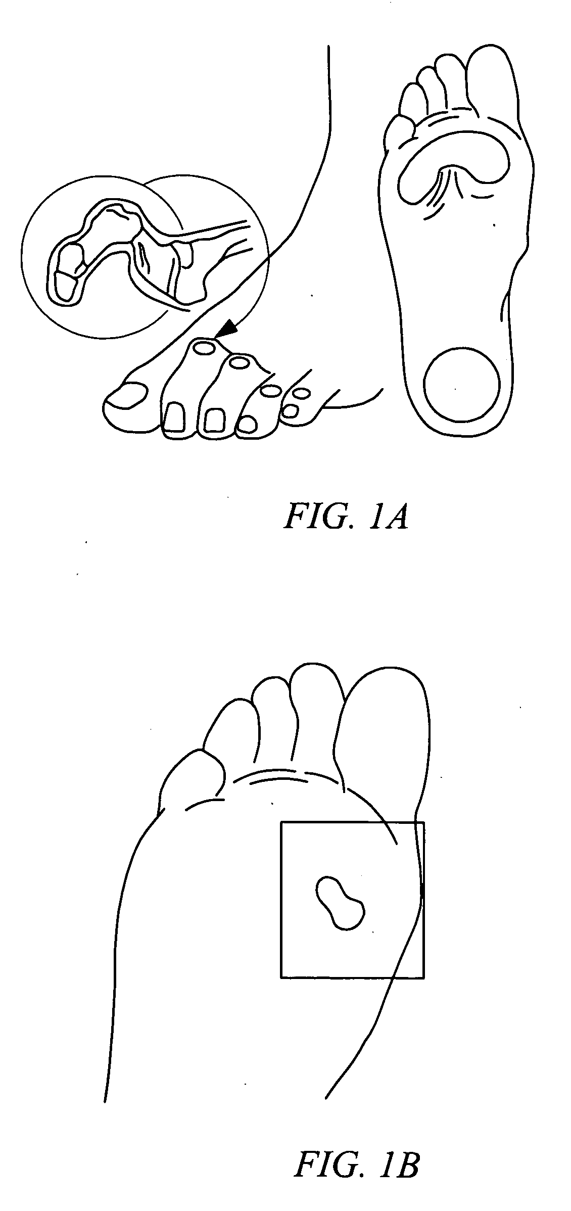 Electrosurgical method and system for treating foot ulcer