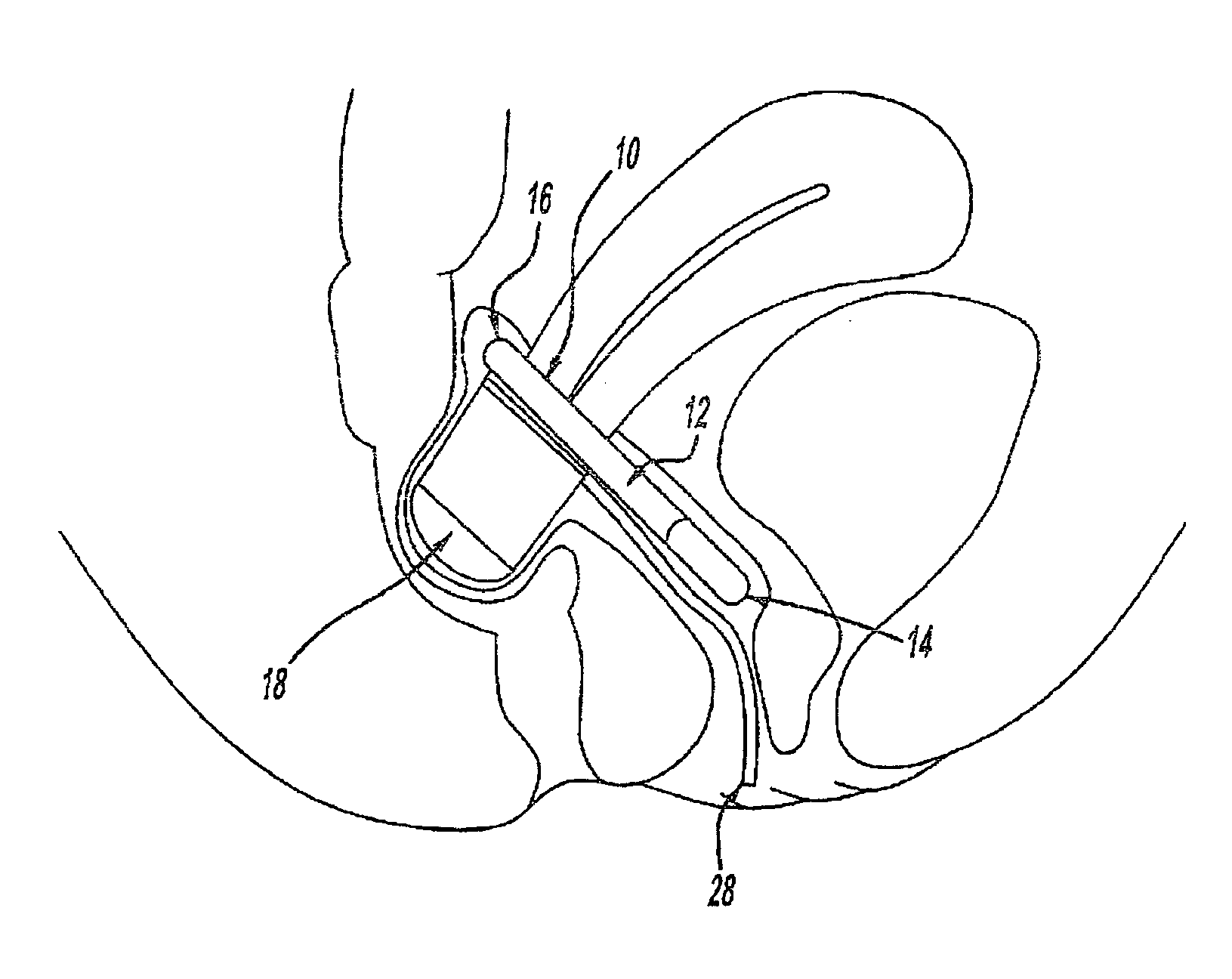 Intra-vaginal device for fecal incontinence
