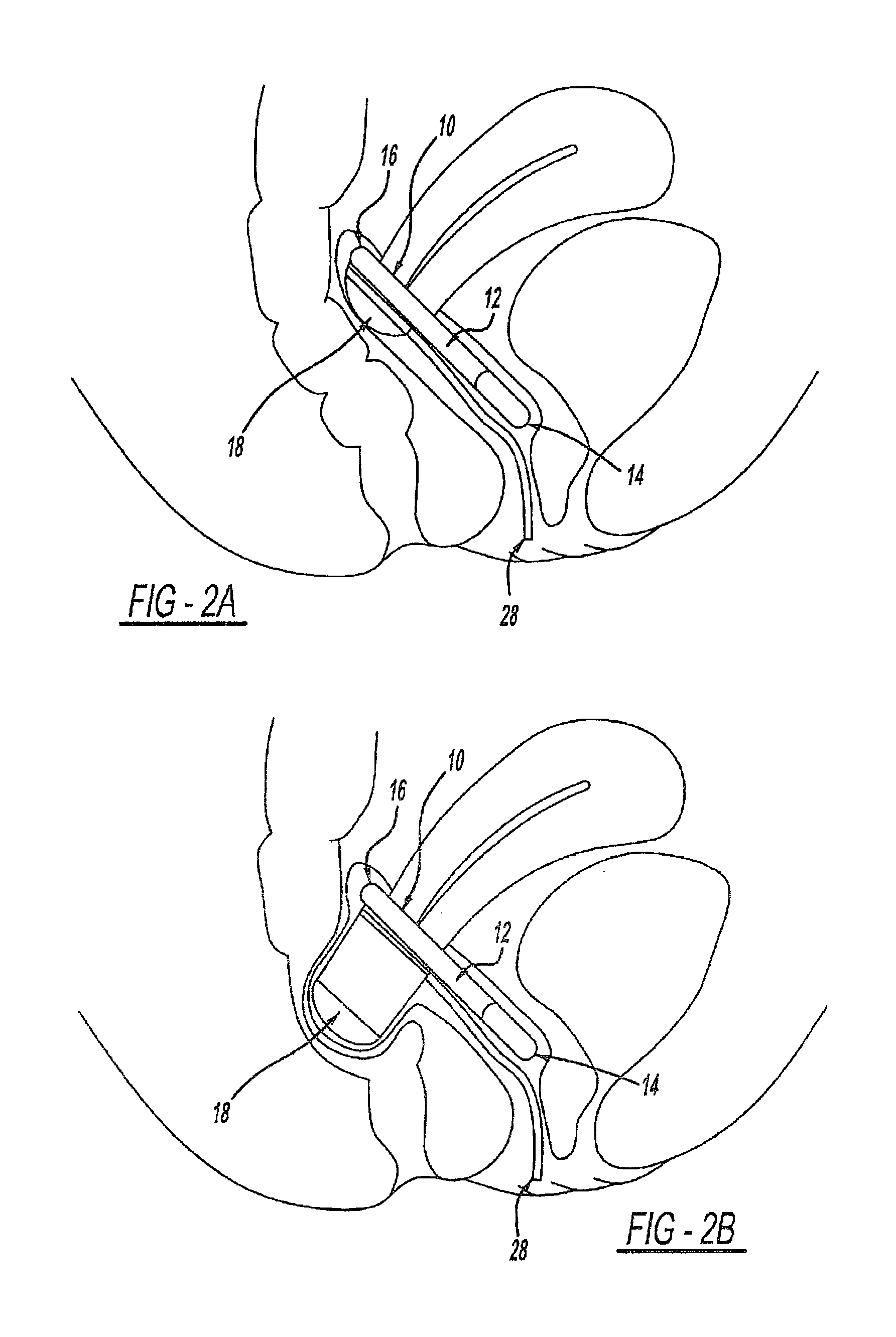 Intra-vaginal device for fecal incontinence