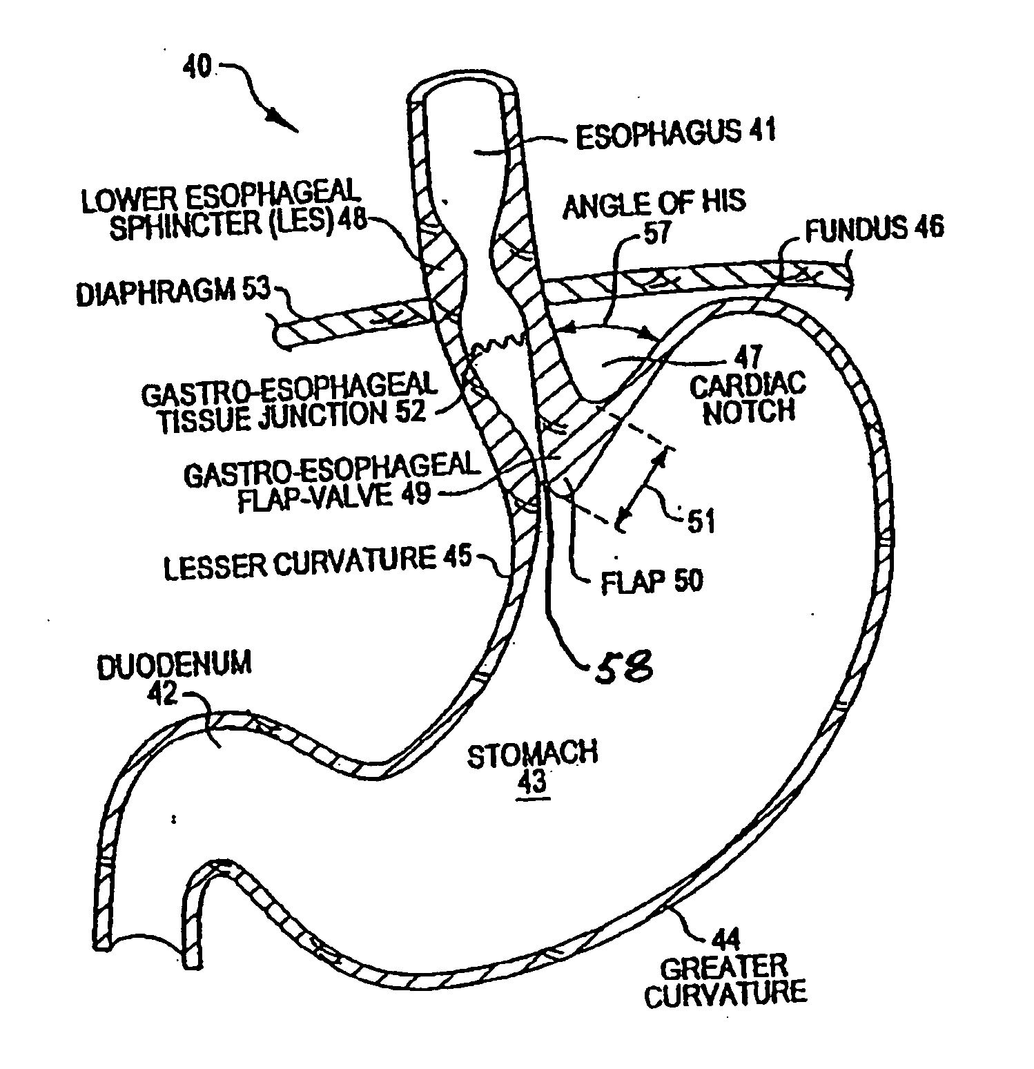 Transesophageal gastric reduction method and device for practicing same