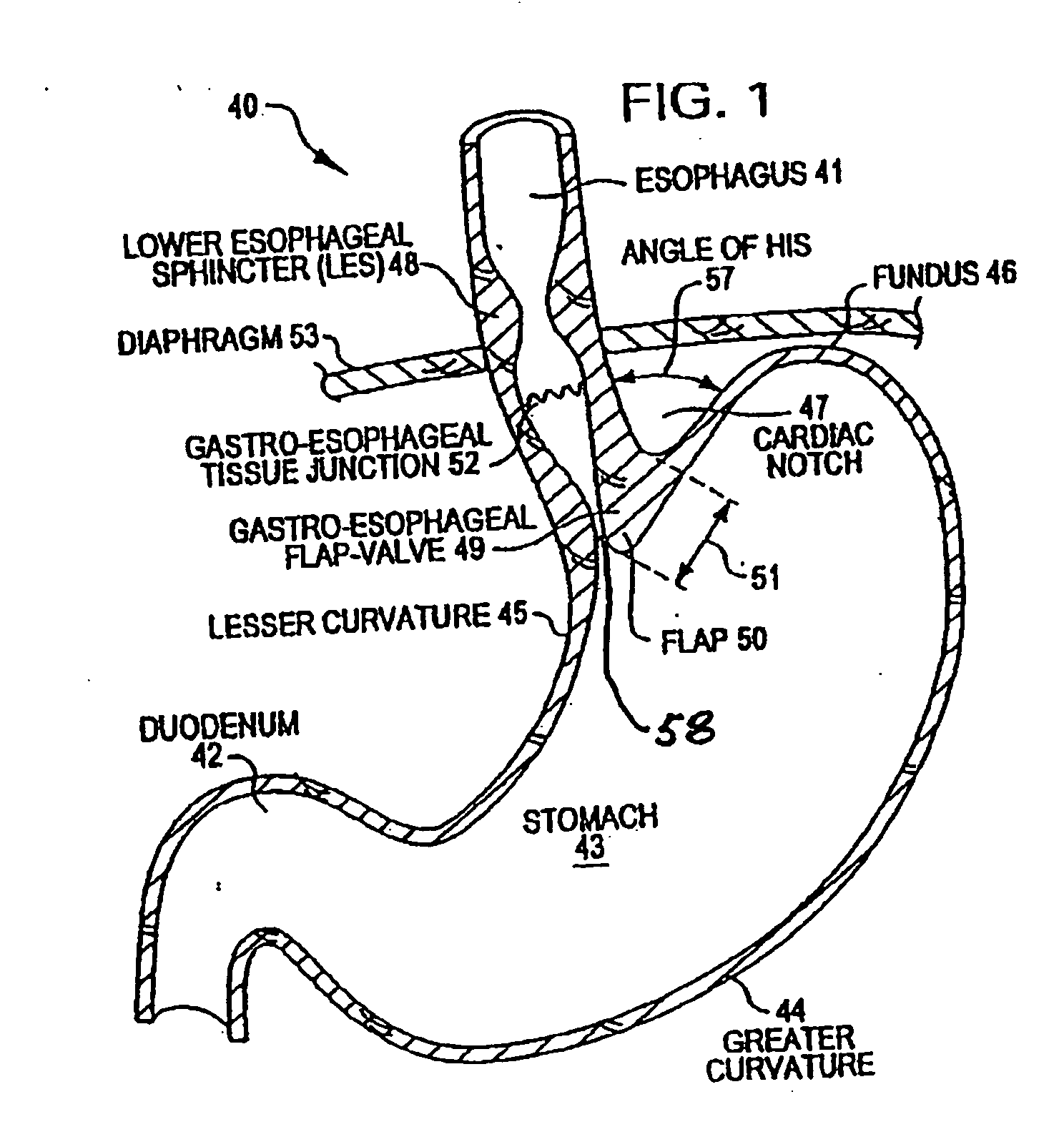 Transesophageal gastric reduction method and device for practicing same