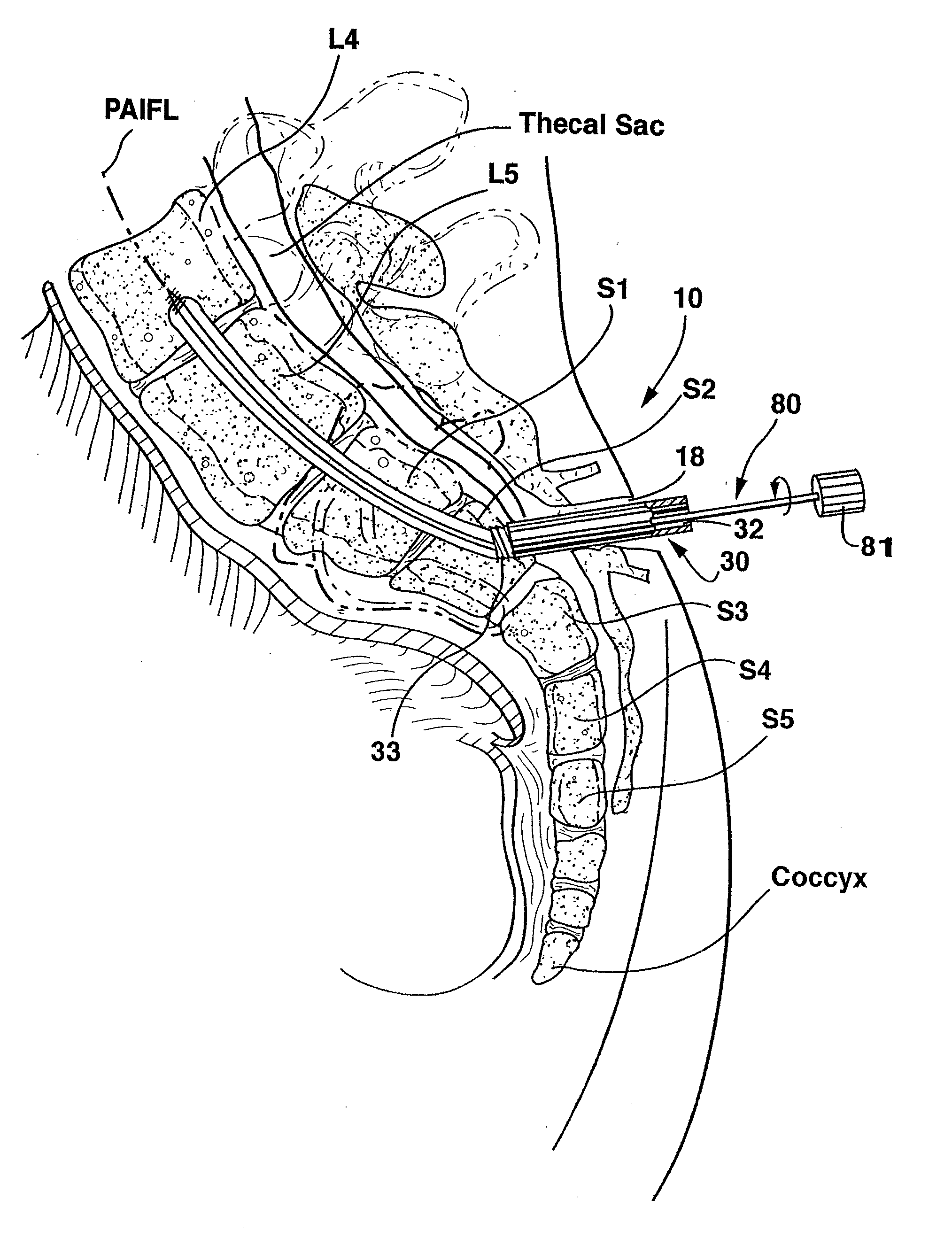 Method and apparatus for providing posterior or anterior trans-sacral access to spinal vertebrae