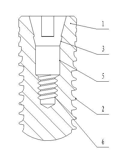 Fixed connecting device for dental implant