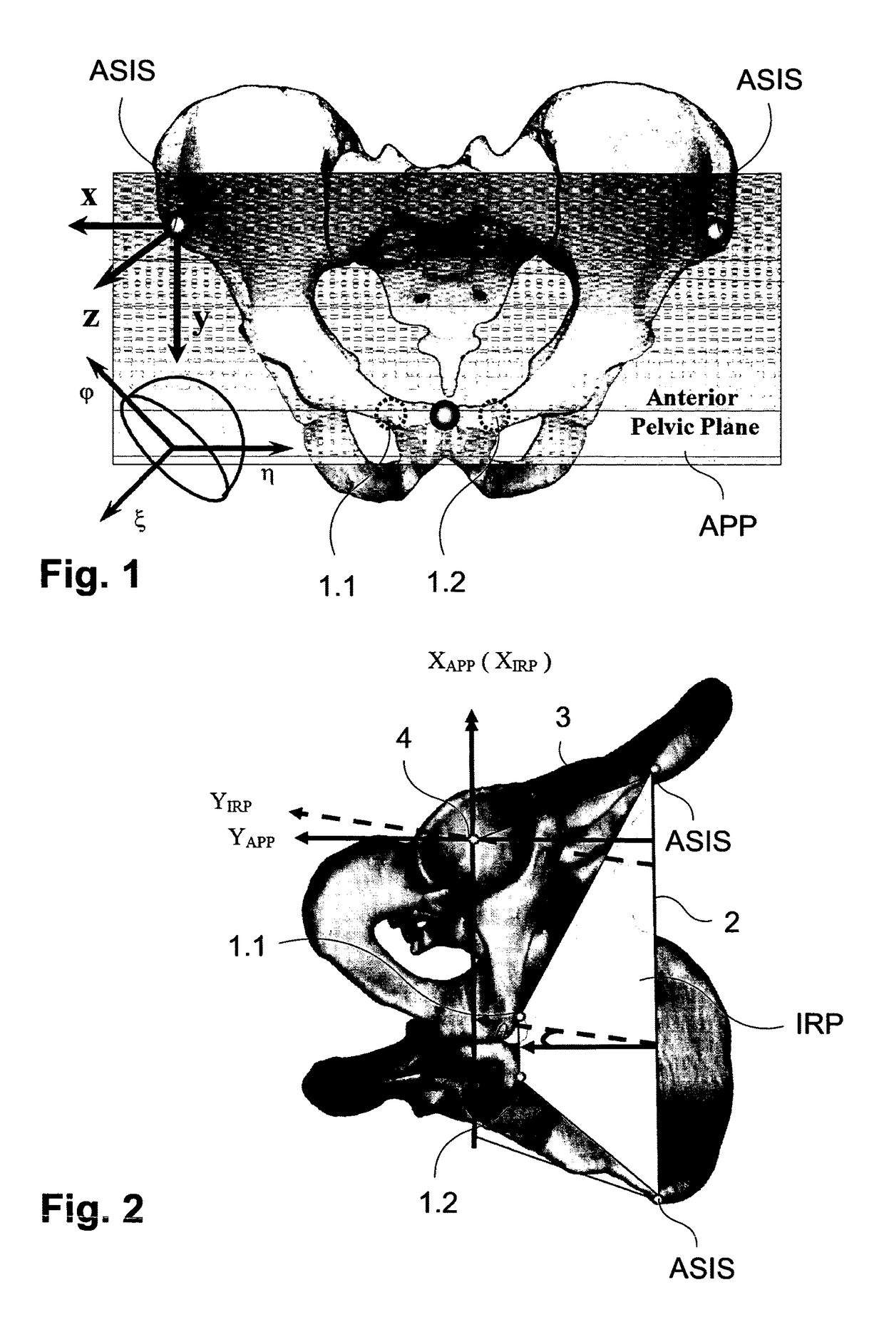 Methods and devices for patient-specific acetabular component alignment in total hip arthroplasty