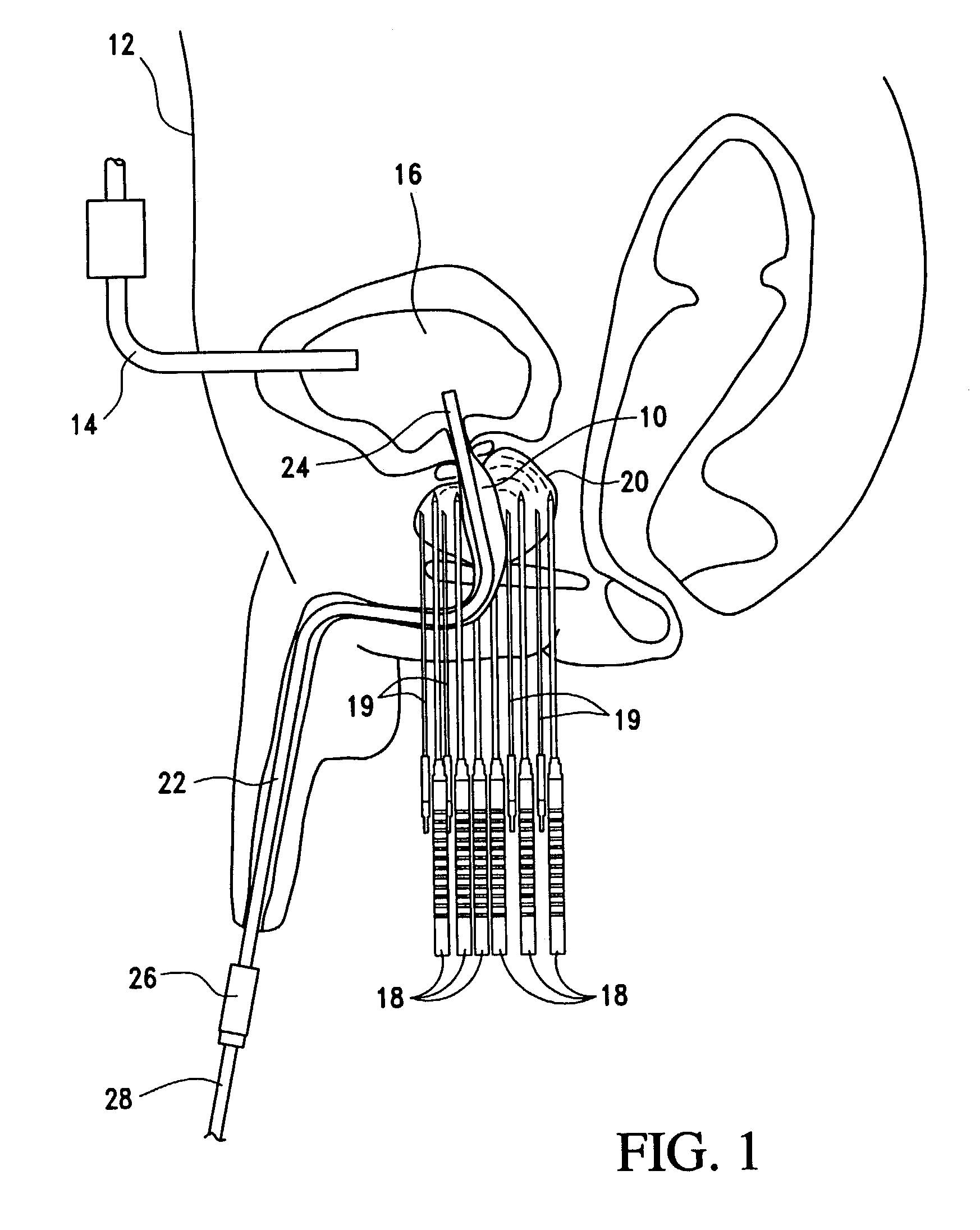 Open system heat exchange catheters and methods of use