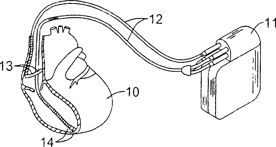 Multiple electrode vectors for implantable cardiac treatment devices