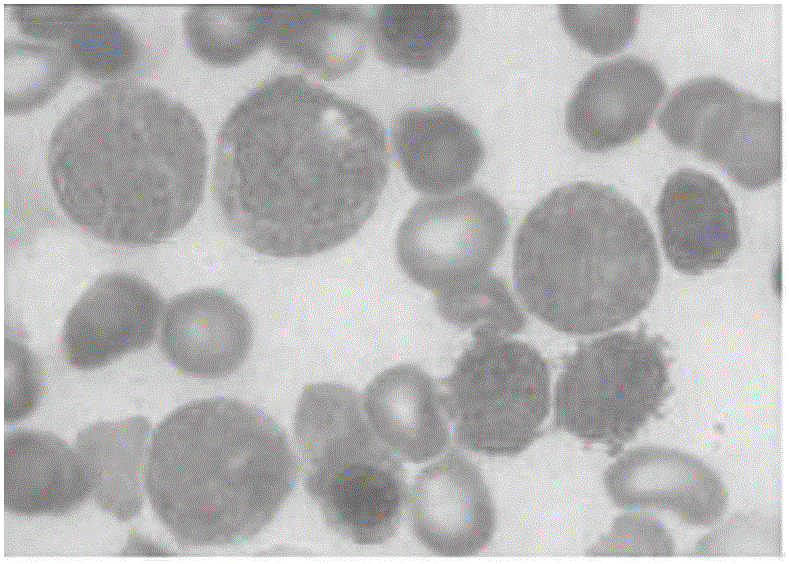 Preparation method of marrow fluid smear