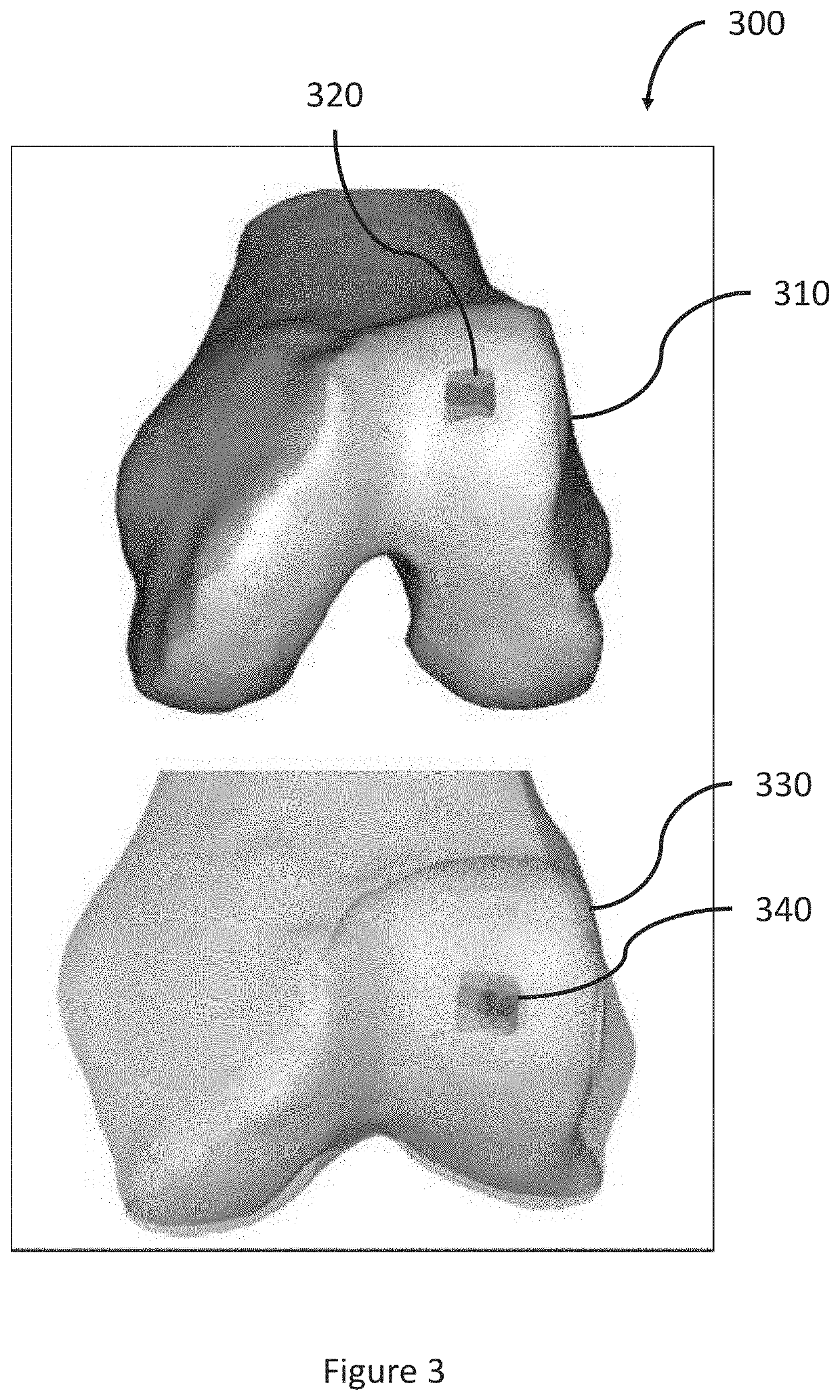 System and method for creating a decision support material indicating damage to an anatomical joint