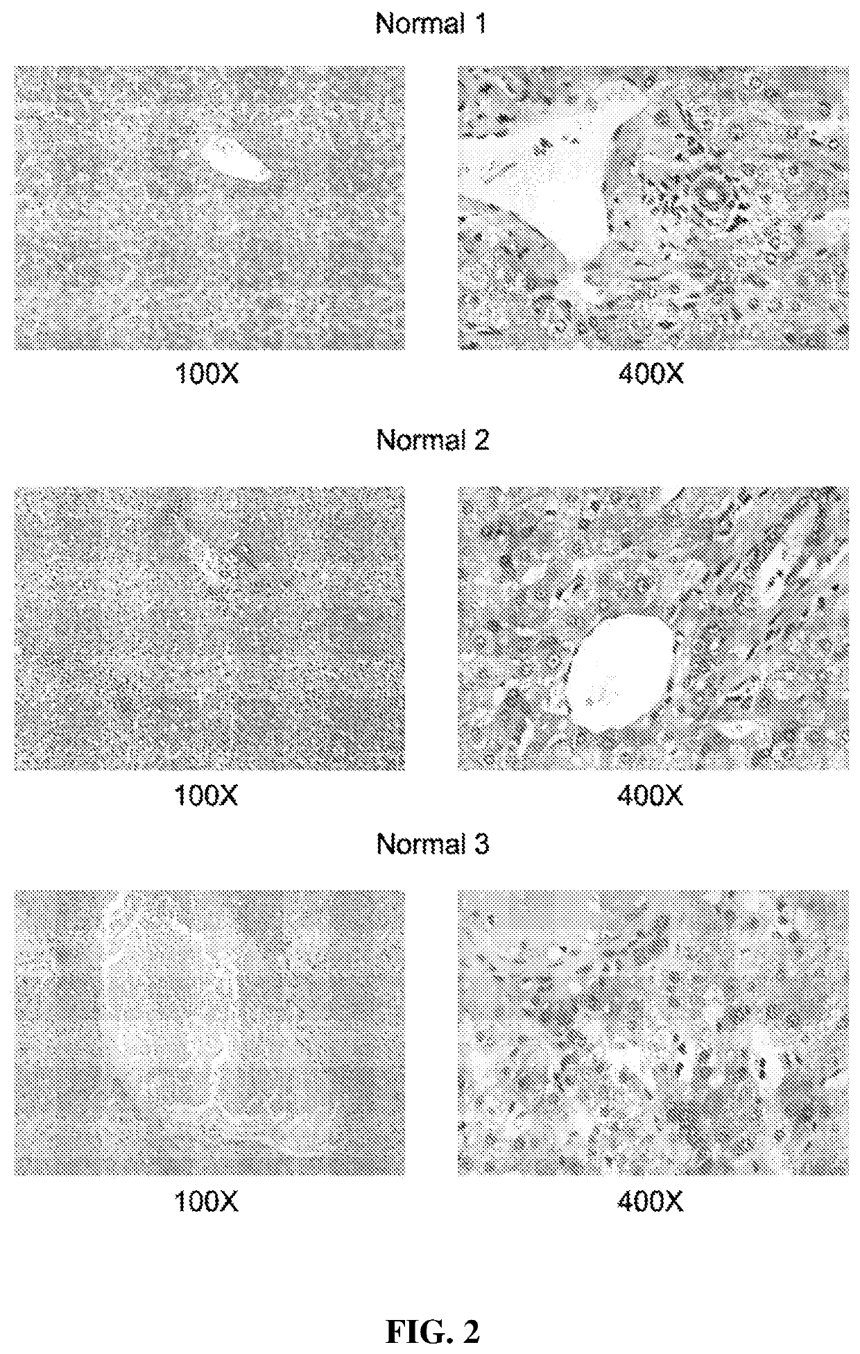 Inhibition of aminocylase 3 (AA3) in the treatment of cancer