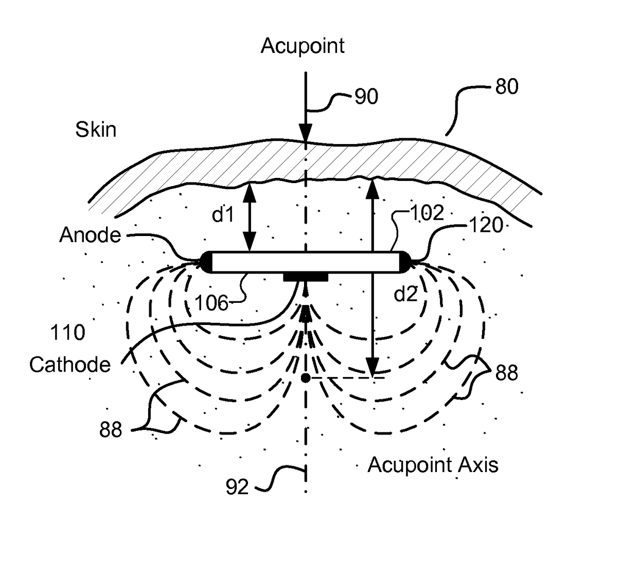 Methods and systems for treating a chronic low back pain condition using an implantable electroacupuncture device