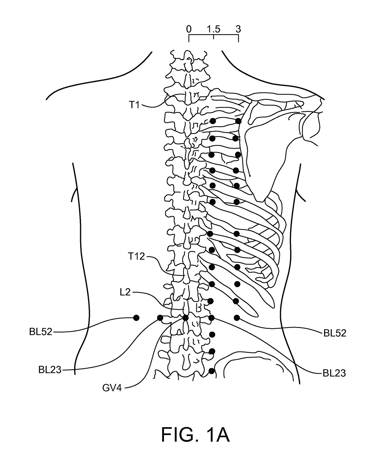 Methods and systems for treating a chronic low back pain condition using an implantable electroacupuncture device