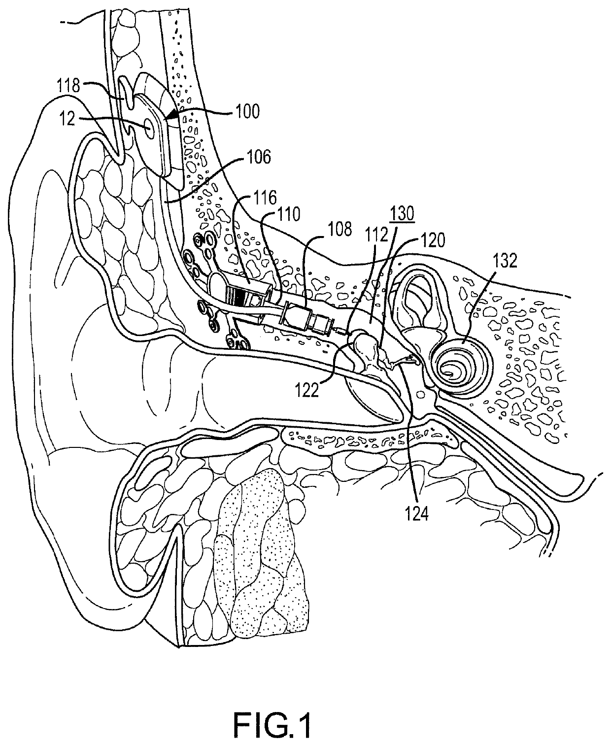 Spanning connector for implantable hearing instrument