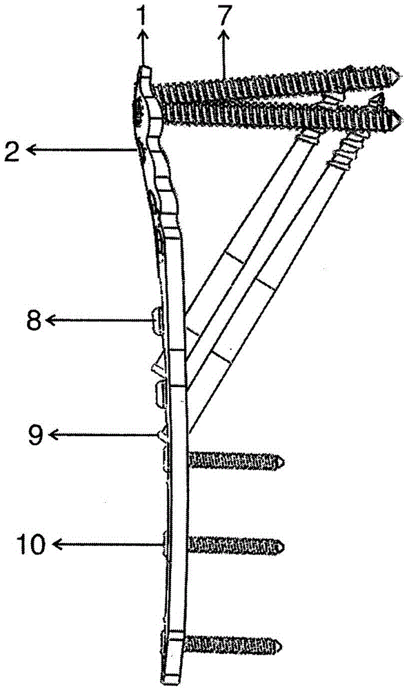 Fracture three-dimensionally-intersecting-connecting-locking internal fixing device