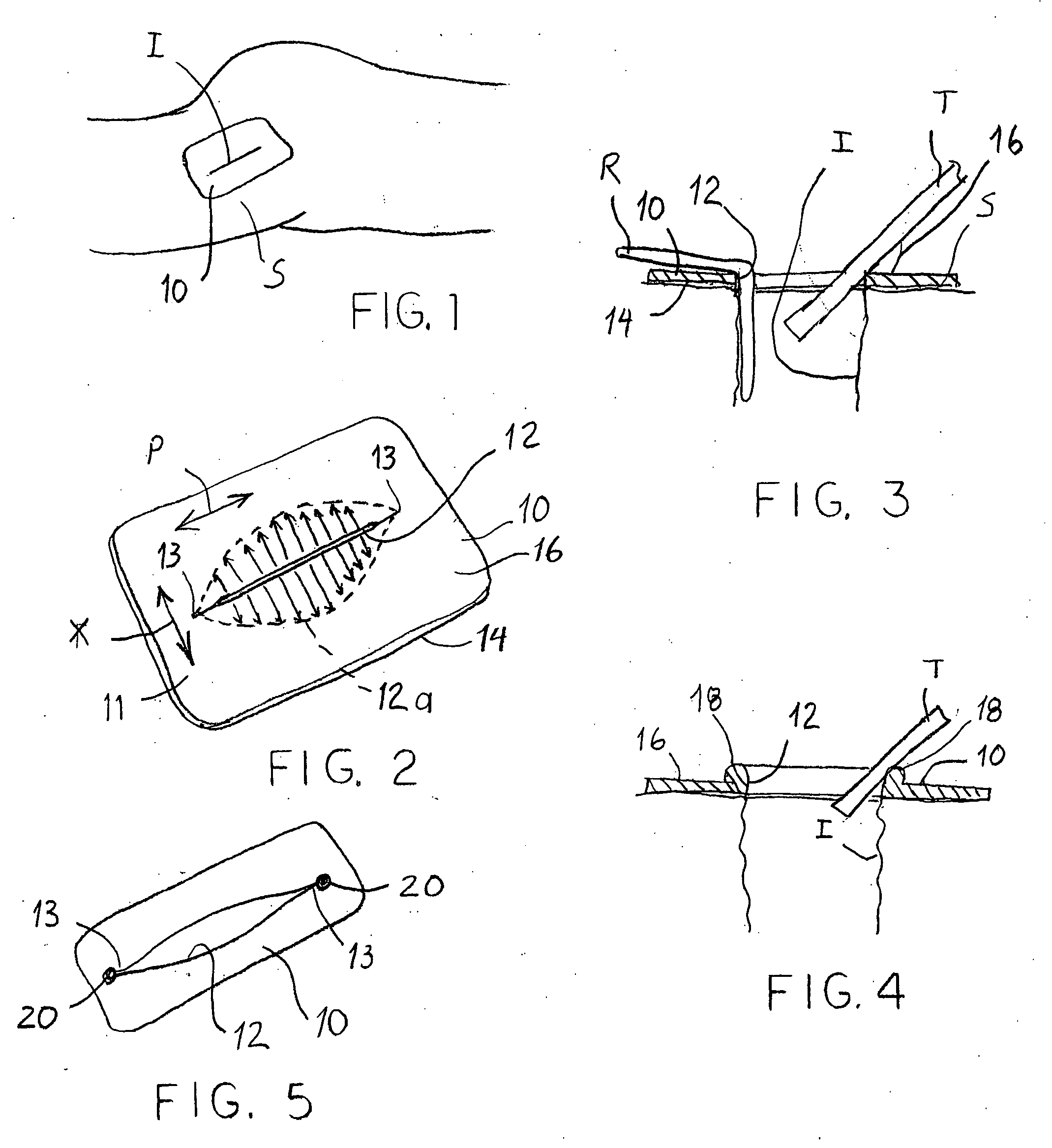 Devices and methods for protecting tissue at a surgical site