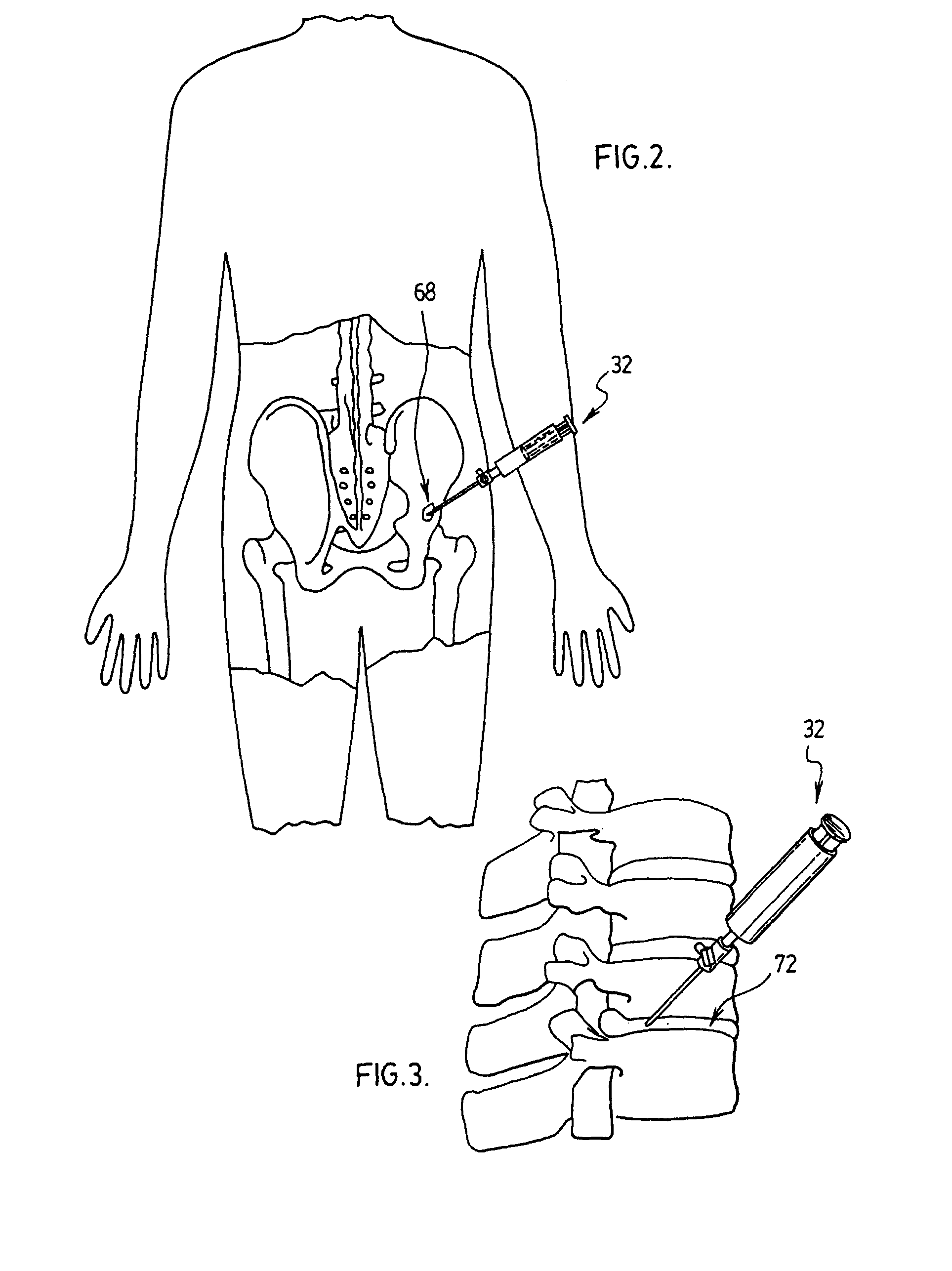 Method for administering a therapeutic agent into tissue