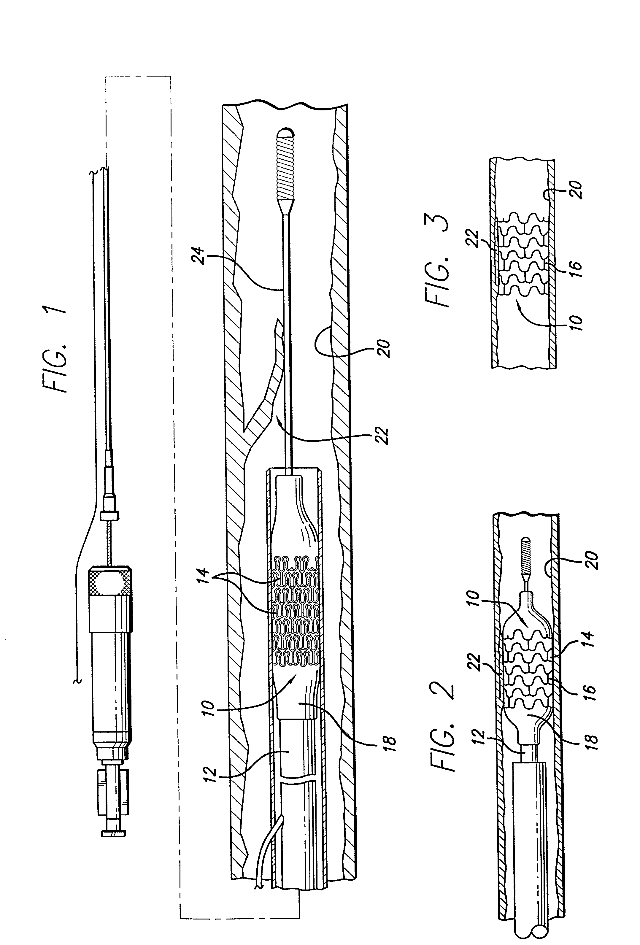 System and method for improved stent retention