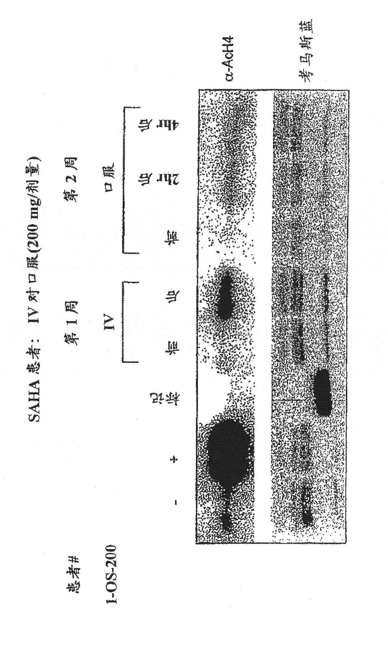 Method of treating cancer with HDAC inhibitors